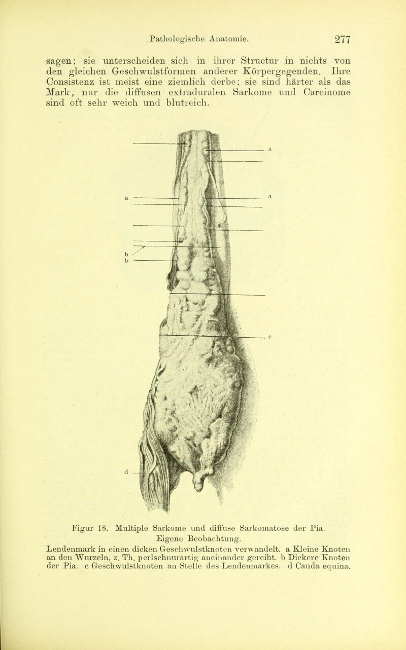 sagen; sie untersclieiden sich in ihrer Structur in niclits von den gleichen Geschwulstformen anderer Korpergegenden. Hire Consistenz ist meist eine ziemlich derbe; sie sind harter als das Mark, nur die diffusen extraduralen Sarkome und Carcinome sind oft sehr weich und blutreich. Figur 18. Multiple Sarkome und diffuse Sarkomatose der Pia. Eigene Beobachtung. Lendenmark in einen dicken G-eschwulstknoten verwandelt. a Kleine Knoten an den Wurzeln, z. Th. perlschnurartig aneinander gereiht. b Dickere Knoten der Pia. c G-eschwulstknoten an Stelle des Lendenmarkes. d Cauda equina.