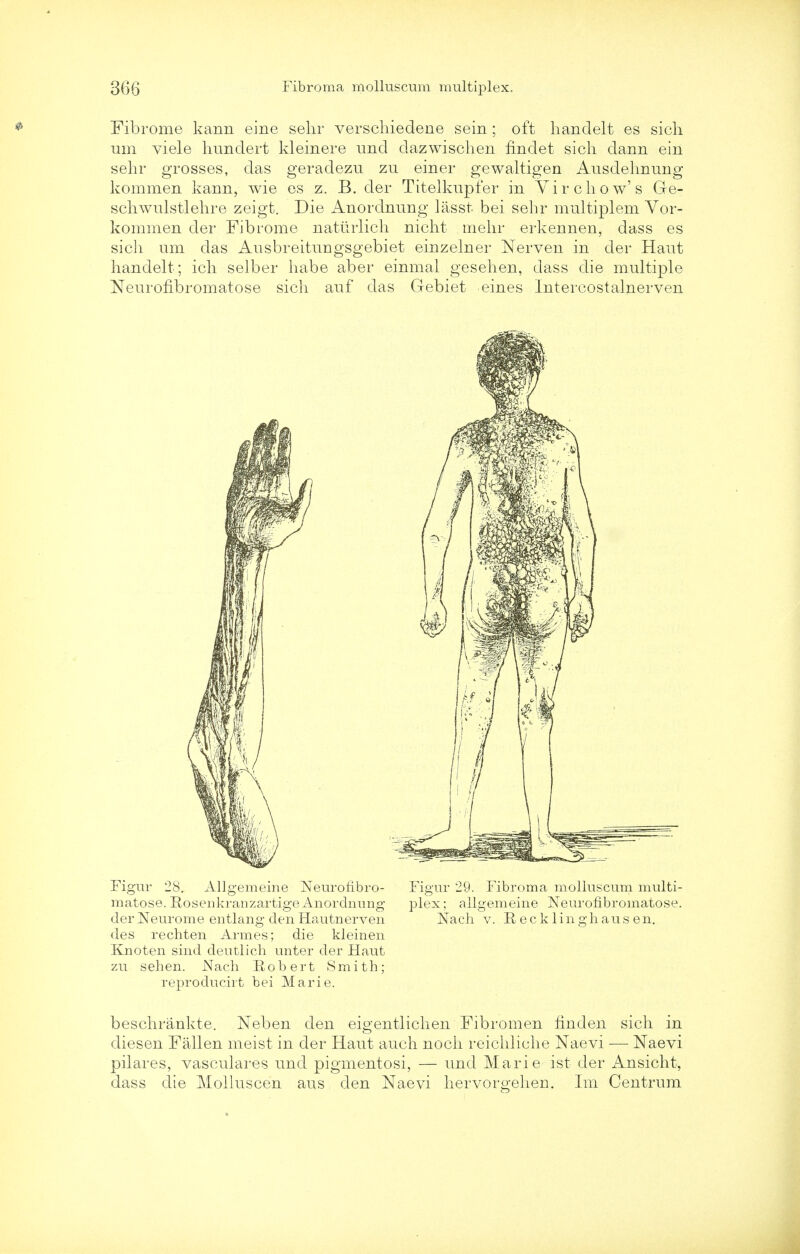 Fibrome kann eine selir verschiedene sein ; oft liandelt es sich urn viele hundert kleinere und dazwischen fmdet sich dann ein sehr grosses, das geradezu zu einer gewaltigen Ausdelmung kommen kann, wie es z. B. der Titelkupfer in Vir chow's Ge- schwulstlelire zeigt. Die Anordnung lasst bei sehr multiplem Vor- kommen der Fibrome natlirlich nicht mehr erkennen, dass es sich urn das Ausbreitungsgebiet einzelner Nerven in der Haut liandelt; ich selber habe aber einmal gesehen, dass die multiple Neurofibromatose sich auf das Gebiet eines Intercostalnerven Figur 28. Allgemeine Neurofibro- matose. Roseukranzartige Anordnnng der Neurome entlang den Hautnerven des rechten Armes; die kleinen Knoten sind dentlich miter der Haut zu sehen. Nach Robert Smith; reproducirt bei Marie. Figur 29. Fibroma molluscum multi- plex; allgemeine Neurofibromatose. Nach v. Recklinghausen. beschrankte. Neben den eigentlichen Fibromen finden sich in diesen Fallen meist in der Haut audi noch reichliche Naevi — Naevi pilares, vasculare? und pigmentosi, — und Marie ist der Ansicht, dass die Molluscen aus den Naevi hervorgehen. Im Centrum