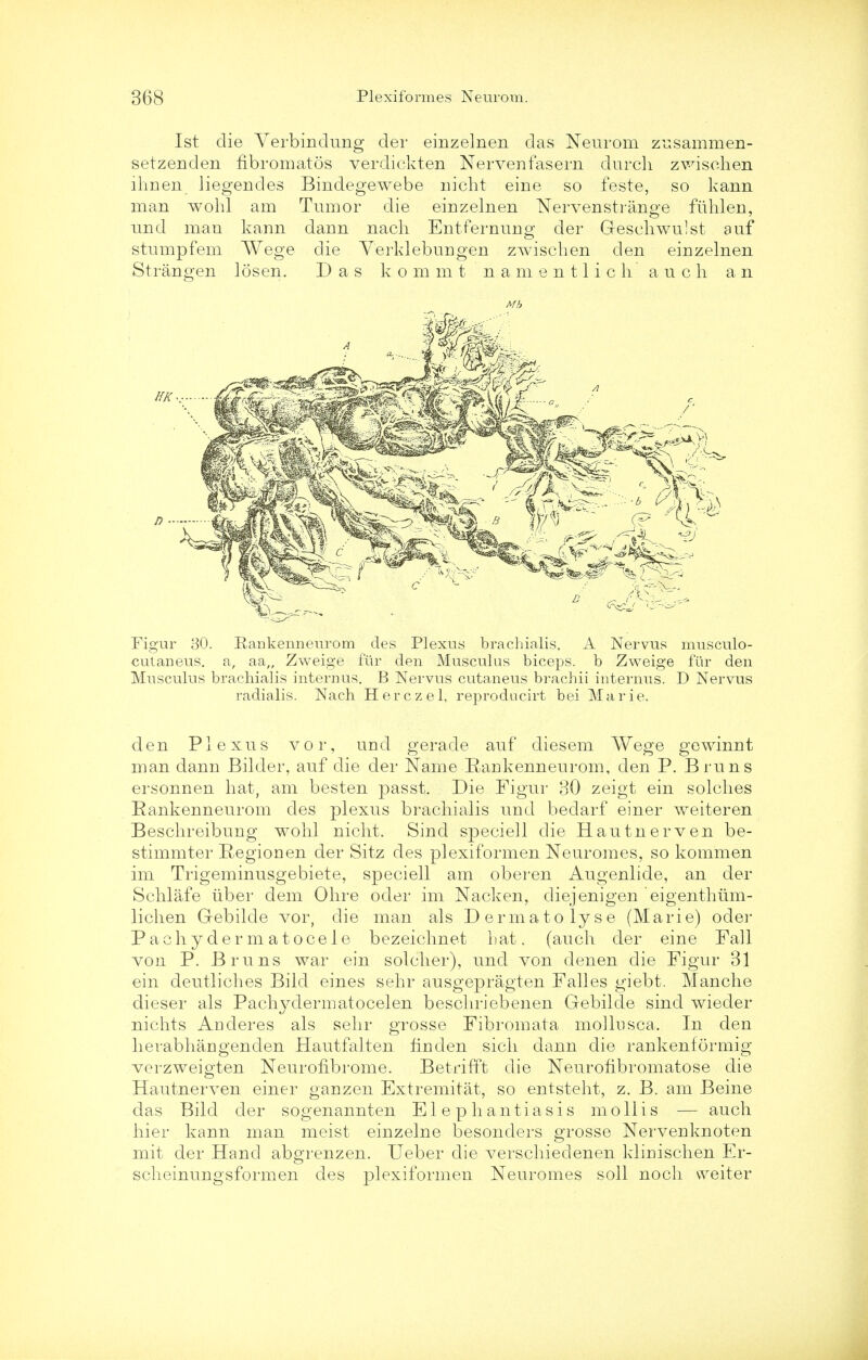 1st die Verb in clung der einzelnen das Neurom zusammen- setzenden fibromatos verdickten Nervenfasern durch z wis oh en ihnen liegendes Bindegewebe nicht eine so feste, so kann man wohl am Tumor die einzelnen Nervenstrange fiihlen, und man kann dann nach Entfernuno- der Geschwuist auf stump fern Wege die Verklebungen zwischen den einzelnen Strangen losen. Das k o m m t n a m e n 11 i c h a u c h an Mb Figur 30. Rankenneurom des Plexus brachialis. A Nervus lmisculo- cutaneus. a, aa„ Zweige fiir den Musculus biceps, b Zweige fur den Musculus brachialis internus. B Nervus cutaneus brachii internus. D Nervus radialis. Nach Herczel, reproducirt bei Marie. den Plexus vor, und gerade auf diesem Wege gewinnt man dann Bilder, auf die der Name Rankenneurom, den P. Bruns ersonnen hat, am besten passt, Die Figur 30 zeigt ein solches Rankenneurom des plexus brachialis und bedarf einer Aveiteren Beschreibung wohl nicht. Sind speciell die Hautnerven be- stimmter Regionen der Sitz des plexiformen Neuromes, so kommen im Trigeminusgebiete, speciell am oberen Augenlide, an der Schlafe iiber dem Ohre oder im Nacken, diejenigen eigenthum- lichen Qebilde vor, die man als Dermatolyse (Marie) oder Pachydermatocele bezeichnet hat. (audi der eine Fall von P. Bruns war ein solcher), und von denen die Figur 31 ein deutliches Bild eines sehr ausgepragten Falles giebt. Manche dieser als Pachydermatocelen beschriebenen Gebilde sind wieder nichts ADderes als sehr grosse Fibromata mollusca. In den herabhangenden Hautfalten finden sich dann die rankenformig verzweigten Neurofibrome. Betrifft die Neurofibromatose die Hautnerven einer ganzen Extremitat, so entsteht, z. B. am Beine das Bild der sogenannten Elephantiasis mollis — audi hier kann man meist einzelne besonders grosse Nervenknoten mit der Hand abgrenzen. Ueber die verschiedenen klinischen Er- scheinungsformen des plexiformen Neuromes soil noch vveiter