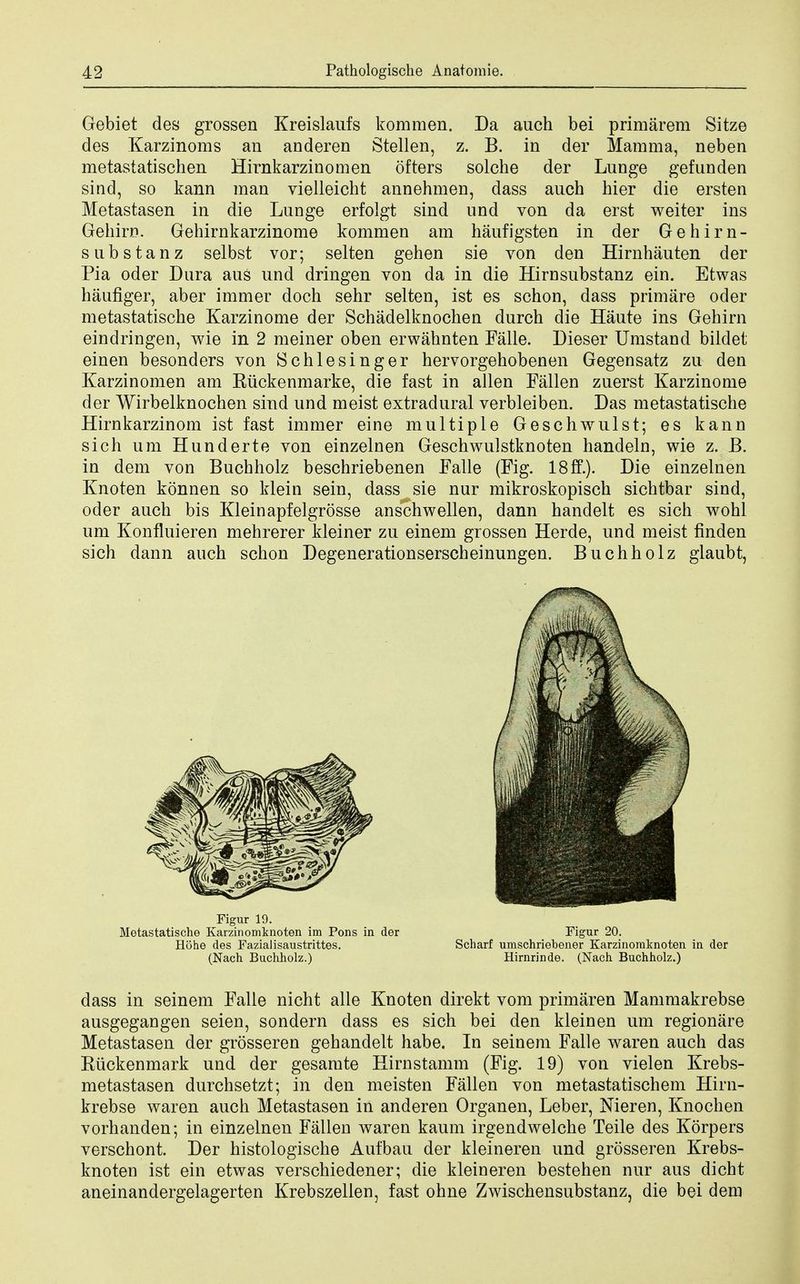 Gebiet des grossen Kreislaufs kommen. Da auch bei primarem Sitze des Karzinoms an anderen Stellen, z. B. in der Mamma, neben metastatischen Hirnkarzinomen ofters solche der Lunge gefunden sind, so kann man vielleicht annehmen, dass auch hier die ersten Metastasen in die Lunge erfolgt sind und von da erst weiter ins Gehirr>. Gehirnkarzinome kommen am haufigsten in der Gehirn- substanz selbst vor; selten gehen sie von den Hirnhauten der Pia oder Dura aus und dringen von da in die Hirnsubstanz ein. Etwas haufiger, aber immer doch sehr selten, ist es schon, dass primare oder metastatische Karzinome der Schadelknochen durch die Haute ins Gehirn eindriagen, wie in 2 meiner oben erwahnten Falle. Dieser Umstand bildet einen besonders von Schlesinger hervorgehobenen Gegensatz zu den Karzinomen am Kiickenmarke, die fast in alien Fallen zuerst Karzinome der Wirbelknochen sind und meist extradural verbleiben. Das metastatische Hirnkarzinom ist fast immer eine multiple Geschwulst; es kann sich um Hunderte von einzelnen Geschwulstknoten handeln, wie z. B. in dem von Buchholz beschriebenen Falle (Fig. 18ff.). Die einzelnen Knoten konnen so klein sein, dass sie nur mikroskopisch sichtbar sind, oder auch bis Kleinapfelgrosse anschwellen, dann handelt es sich wohl um Konfluieren mehrerer kleiner zu einem grossen Herde, und meist finden sich dann auch schon Degenerationserscheinungen. Buchholz glaubt, dass in seinem Falle nicht alle Knoten direkt vom primaren Mammakrebse ausgegangen seien, sondern dass es sich bei den kleinen um regionare Metastasen der grosseren gehandelt habe. In seinem Falle waren auch das Kuckenmark und der gesamte Hirnstamm (Fig. 19) von vielen Krebs- metastasen durchsetzt; in den meisten Fallen von metastatischem Hirn- krebse waren auch Metastasen in anderen Organ en, Leber, Nieren, Knochen vorhanden; in einzelnen Fallen waren kaum irgendwelche Teile des Korpers verschont. Der histologische Aufbau der kleineren und grosseren Krebs- knoten ist ein etwas verschiedener; die kleineren bestehen nur aus dicht aneinandergelagerten Krebszellen, fast ohne Zwischensubstanz, die bei dem Figur 19. Metastatische Karzinomfcnoten im Pons in der Hohe des Fazialisaustrittes. (Nach Buchholz.) Figur 20. Scharf umschriebener Karzinomknoten in der Hirnrinde. (Nach Buchholz.)