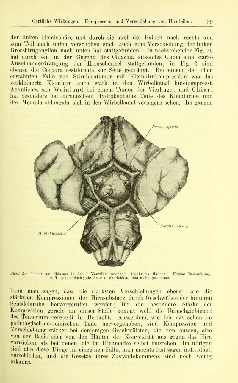 cler linken Hemisphere und durch sie auch der Balken nach rechts und zum Teii nach unten verschoben sind; auch eine Verschiebung der linken Grosshirnganglien nach unten hat stattgefunden. In nachstehender Fig. 25 hat durch ein in der Gegend des Chiasma sitzendes Gliom eine starke Auseinanderdrangung der Hirnschenkel stattgefunden; in Fig. 2 sind ebenso die Corpora restiformia zur Seite gedrangt. Bei einem der oben erwahnten Falle von Stirnhirn tumor mit Kleinhirnkompression war das verkleinerte Kleinhirn auch stark in den Wirbelkanal hineingepresst. Aehnliches sah Weinland bei einem Tumor der Vierhugel, und Chiari hat besonders bei chronischem Hydrokephalus Teile des Kleinhirnes und der Medulla oblongata sich in den Wirbelkanal verlagern sehen. Im ganzen Figur 25. Tumor am Chiasma in den 3. Ventrikel reichend. 18jahriges Madchen. Eigene Beobachtnng; z. T. schematisch; die Arteriae chorioideae sind nicht gezeichnet. kann man sagen, dass die starksten Yerschiebungen ebenso wie die starksten Kompressionen der Hirnsubstanz durch Geschwiilste cler hinteren Schadelgrube hervorgerufen werden; fiir die besondere Starke der Kompression gerade an dieser Stelle kommt wohl die Unnachgiebigkeit des Tentorium cerebelli in Betracht. Ausserdem, wie ich das schon im pathologisch-anatomischen Teile hervorgehoben, sind Kompression und Yerschiebnng starker bei denjenigen Geschwiilsten, die von aussen, also von der Basis oder von den Hauten der Konvexitat aus gegen das Hirn vorriicken, als bei denen, die im Hirnmarke selbst entstehen. Im iibrigen sind alle diese Dinge im einzelnen Falle, man mochte fast sagen individuell verschieden, und die Gesetze ihres Zustandekommens sind noch wenig erkannt.