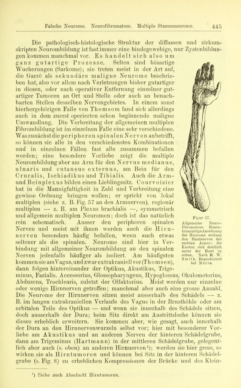 Die pathologisch-histologische Struktur der diffussen und zirkum- skripten Neurombildung istfastimmer eine bindegewebige, nur Zysteubildun- gen kommen mancbmal vor. E s h a n d e 11 s i c b also u m ganz gutartige Prozesse. Selten sind bosartige AVucherungen (Sarkome); sie treten meist in der Art auf, die Garre als sekundare maligne Neurome beschrie- ben hat, also vor all em nach Verletzungen bisber gutartiger in diesen, oder nach operativer Entfernung einzelner gut- artiger Tumoren an Ort und Stelle oder audi an benach- barten Stellen desselben Nervengebietes. In einem sonst hierhergehorigen Falle von Thomsom fand sich allerdings auch in dem zuerst operierten schon beginnende maligne Umwandlung. Die Verbreitung der allgemeinen multiplen Fibrombildung ist im einzelnen Falle eine sehr verscbiedene. Waszumichstdie peripheren spinalen Nerven anbetrifft, so konnen sie alle in den verschiedensten Kombinationen und in einzelnen Fallen fast alle zusammen befallen werden; eine besondere Vorliebe zeigt die multiple Neurombildungaber am Arm fiir den Nervus medianus, ulnaris und cutaneus extern us, am Bein fiir den Cruralis, Ischiadikus und Tibialis. Auch die Arm- und Bein plexus bilden einen Lieblingssitz. Courvoisier hat in die Mannigfaltigkeit in Zalil und Verbreitung eine gewisse Ordnung bringen wollen; er spricht von lokal multiplen (siehe z. B. Fig. 57 an den Armnerven), regioniir multiplen — z. B. am Plexus brachialis —, symmetrisch und allgemein multiplen Neuromen; doch ist das naturlich rein schematisch. Ausser den peripheren spinalen Nerven und meist mit ihnen werden auch die Hirn- nerven besonders haufig befallen, wenn auch etwas seltener als die spinalen. Neurome sind hier in Ver- bindung mit allgemeiner Neurombildung an den spinalen Nerven jedenfalls haufiger als isoliert. Am haufigsten kommen sie am Vagus, und zwar extrakraniell vor (T h o m s e n), dann folgen hintereinander der Optikus, Akustikus, Trige- minus, Fazialis, Accessorius, Glossopharyngeus, Hypoglossus, Okulomotorius, Abduzens, Trochlearis, zuletzt der Olfaktorius. Meist werden nur einzelne oder wenige Hirnnerven getroffen; mancbmal aber auch eine grosse Anzahl. Die Neurome der Hirnnerven sitzen meist ausserhalb des Schadels — z. B. im langen extrakraniellen Verlaufe des Vagus in der Brusthohle oder am orbitalen Teile des Optikus — und wenn sie innerhalb des Schadels sitzen, doch ausserhalb der Dura; beim Sitz direkt am Austrittsloche konnen sie dieses erheblich erweitern. Sie kommen aber, wie gesagt, auch innerhalb der Dura an den Hirnnervenwurzeln selbst vor; hier mit besonderer Vor- liebe am Akustikus und an anderen Nerven der hinteren Schadelgrube, dann am Trigeminus (Hartmann) in der mittleren Scbadelgrube, gelegent- lich aber auch (s. oben) an anderen Hirnnerven1); werden sie hier gross, so wirken sie als Him tumoren und konnen bei Sitz in der hinteren Schadel- grube (s. Fig. 8) zu erheblichen Kompressionen der Briicke und des Klein- Figur 57. Allgoineine Nouro- fibroniatose. Roscii- k ranzartigeAnordnung dor Nourome entiang don Hautnervon des rechten Amies; die Knoten sind deutlich unter der Haut zu sehen. Nach R. W. Smith. Reproduziert bei Marie. J) Siebe auch Abschuitt flirntumoren.