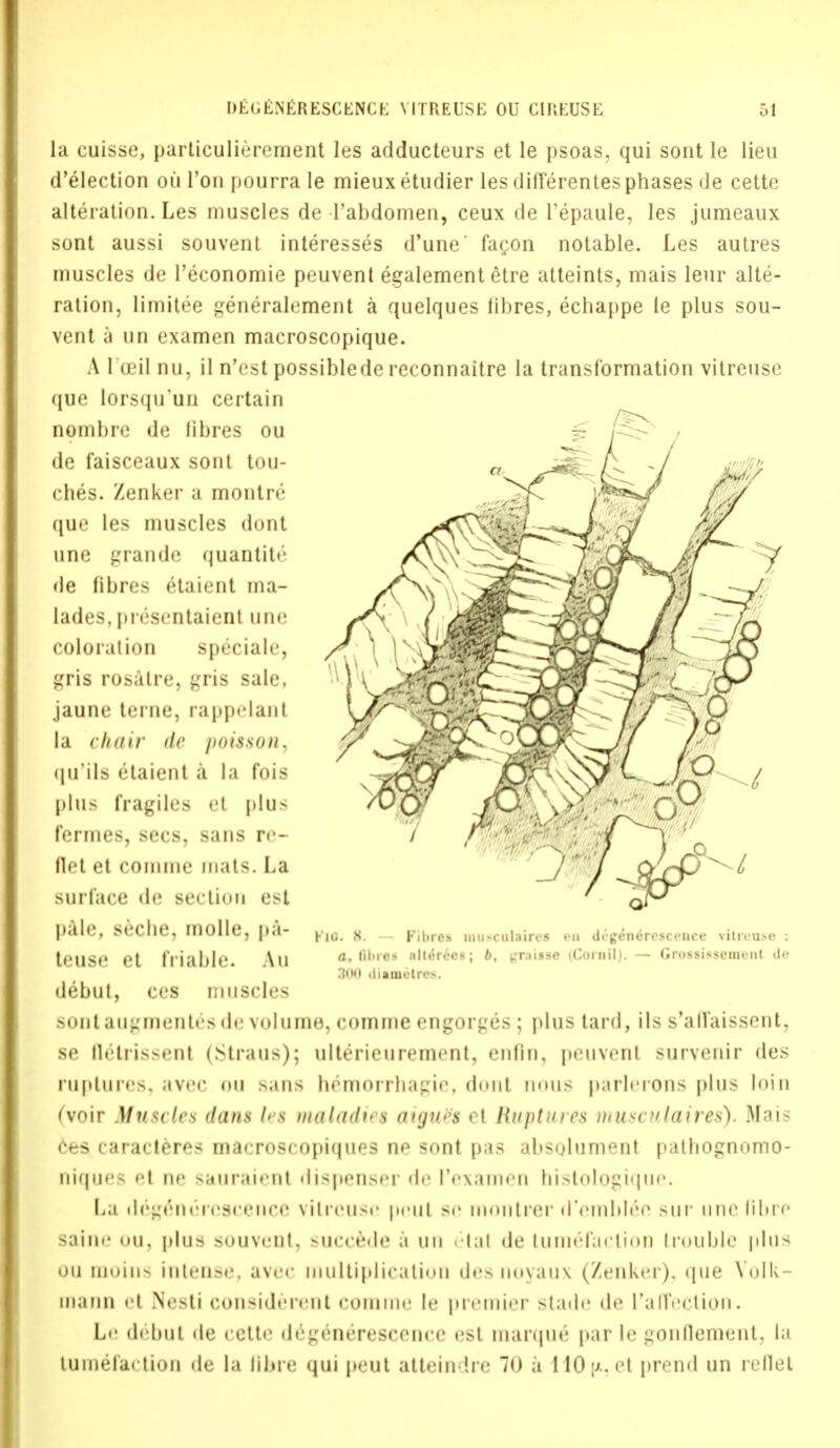 la cuisse, particulierement les adducteurs et le psoas, qui sont le lieu d'election ou Ton pourra le mieuxetudier les diflerentes phases de cette alteration. Les muscles de 1'abdomen, ceux de l'epaule, les jumeaux sont aussi souvent interesses d'une' fa(;on notable. Les autres muscles de l'economie peuvent egalement etre atteints, mais leur alte- ration, limitee generalement a quelques fibres, echappe le plus sou- vent a un examen macroscopique. A 1 oeil nu, il n'est possiblede reconnaitre la transformation vitreuse que lorsqu'un certain nombre de fibres ou de faisceaux sont tou- ches. Zenker a montre que les muscles dont une grande quantity de fibres etaient ma- lades, presentaient une coloration speciale, gris rosatre, ^ris sale, jaune terne, rappelant la chair de jioisson. qtl'ils etaient a la fois pin- fragiles et plus fennes, sees, sans re- Ih't ft comnu' mats. La surface de section est pale, seche, molle, pa- pIC y _ Kii,rcs muscnhurei en digfadreacence vitreuse : tCUS*' Ct rHable AU a, fibres alte>6es; b, irraisse ^Cornil). — Grossissement dc debut, ces muscles sunt augmentes de volume, comme engorges ; plus tard, lis s'all'aissent, se flelrissent (Straus); ulterieurement, enfln, peuvenl survenir des ru[»turrs. avee nu sans hemnnliaLjii\ dnut mnis parlerons plus Inin (voir Muscles dans les maktdies aigutis el Ruptures musculaires). Mais 6es caracteres macroscopiques ne sont pas absolumenl pathognomb- nii|iirv el ne sauraienl dispenser de I'examen histologique. La degenereseeiire vilreuse pent se 11m»111i*or d'emblee sur une (ibre saine nu. |ilus souvnit. Hierede a un etal de tum&aCliOD trouble plus ou moins intense, avec multiplication des noyaux (Zenker), que Volk- mann et Nesti considerent comme le premier stade de I'a ll'cct ion. Le debut de cette degenerescence est marque par le gonnement, la tumefaction de la fibre qui peut attein he 70 a L10(x,et prend un reflet