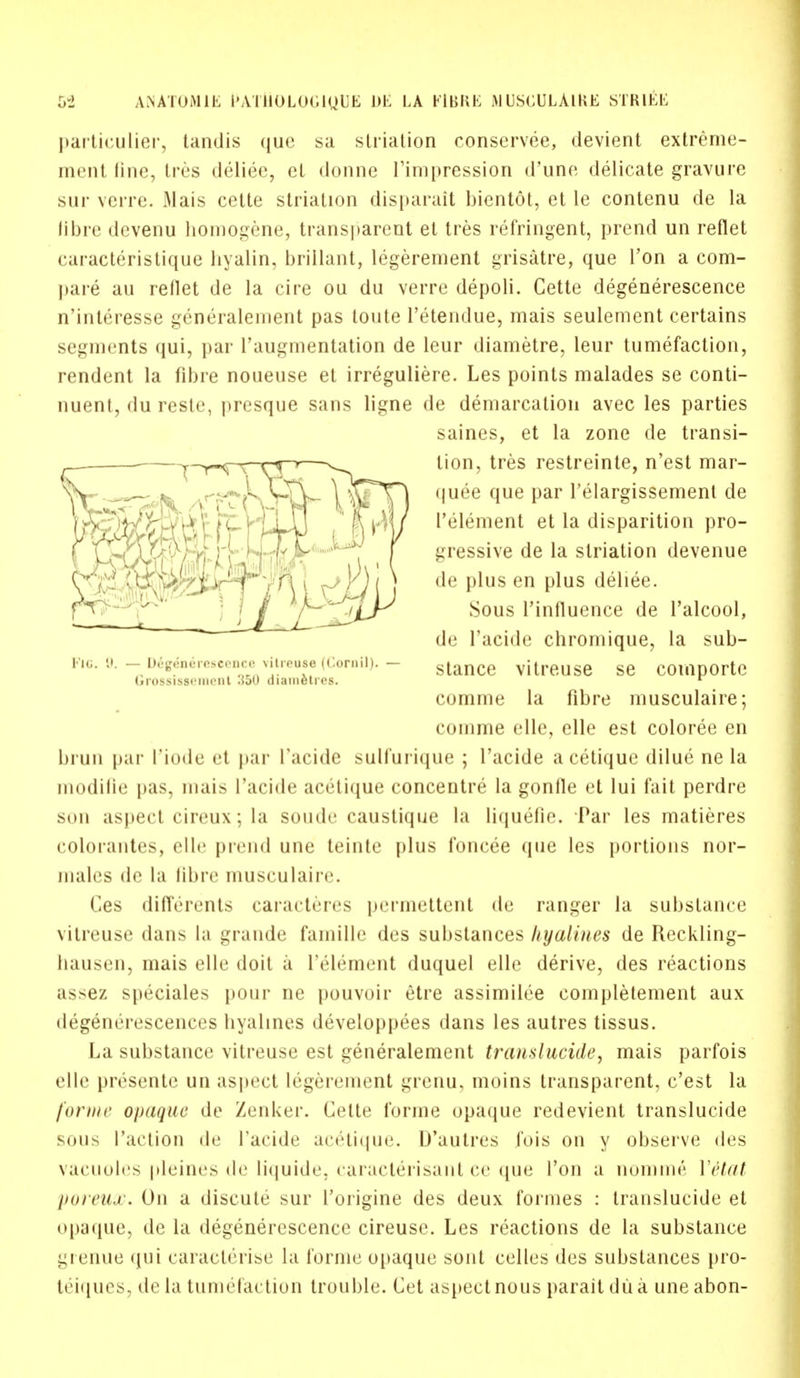 particulier, tandis que sa striation conservee, devient extreme- ment line, Ires deliee, el donne I'impression d'une delicate gravure sur verre. Mais cette striation disparait bicntot, et le contenu de la fibre devenu homogene, transparent el tres refringent, prend un reflet caracteristique hyalin, brillant, legerement grisatre, que Ton a com- pare an reflet de la cire ou du verre depoli. Cette degenerescence n'interesse generalement pas toute l'etendue, mais seulement certains segments qui, par l'augmentation de leur diametre, leur tumefaction, rendent la fibre noueuse et irreguliere. Les points malades se conti- nuent, du resle, presque sans ligne de demarcation avec les parties saines, et la zone de transi- tion, tres restreinte, n'est mar- quee que par l'elargissement de I'element et la disparition pro- gressive de la striation devenue de plus en plus deliee. Sous Tinfluence de l'alcool, de l'acide chromique, la sub- stance vitreuse se comportc comme la fibre musculaire; comme elle, elle est coloree en brun par I'iode <ii par l'acide sulfurique ; l'acide acetique dilue ne la modifie pus. mais l'acide acetique concentre la gonfle et lui fait perdre son aspect cireux; la soude caustique la liquefie. Par les matieres colorantes, elle prend une teinte plus foncee que les portions nor- males de la fibre musculaire. Ces differents caracteres permettent de ranger la subslance vitreuse dans la grande famille des substance> hyalines de Reckling- hausen, mais elle doit a I'element duquel elle derive, des reactions assez speciales pour ne pouvoir etre assimilee completement aux degenerescences hyalines developpees dans les autres tissus. La substance vitreuse est generalement translucide, mais parfois elle presente un aspect legerement grenu, moins transparent, c'est la forme opaque de Zenker. Cette forme opaque redevient translucide sons ['action de l'acide acetique. D'autres fois on y observe des vacuoles pleines de liquide, caracterisant ce que Ton a nomme Yrt/tf poreux. On a discute sur l'origine des deux formes : translucide et opaque, de La degenerescence cireuse. Les reactions de la substance grenue qui caracterise la forme opaque sont celles des substances pro- teiques, de la tumefaction trouble. Cct aspect nous parait du a une abon- Fio. 9. — D6g^n6reseence vitreuse (Cornil). — (Iriississt'iiiciit ::C><i (iiainfeti es.