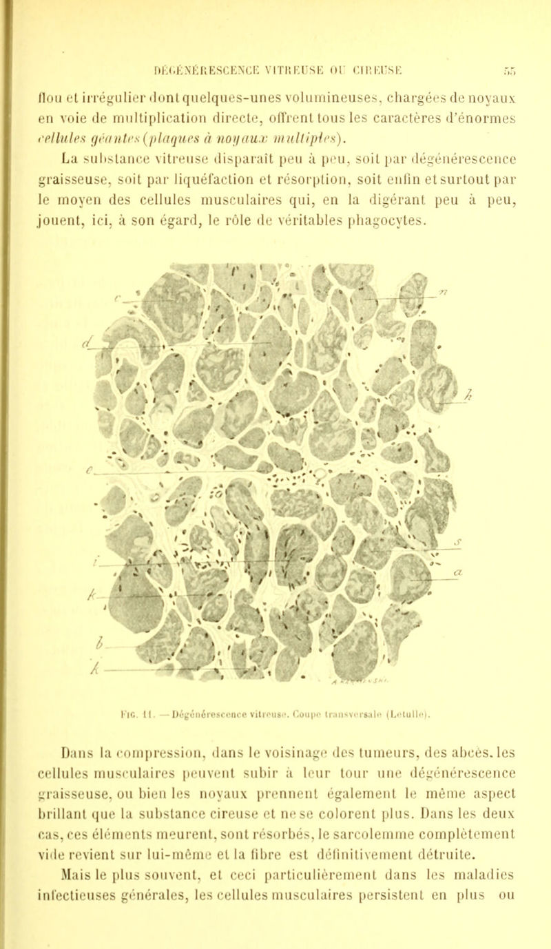 flou et irregulier dontquelques-unes volumineuses, chargees de noyaux en voie de multiplication directe, ofTrent tous les caracteres d'enormes cellules geantes (plaques u noyaux multiples). La substance vitrense disparait peu a peu, soit par degenerescence graisseuse, soit par liquefaction et resorption, soit enfin etsurtoutpar le moyen des cellules musculaires qui, en la digerant peu a peu, jouent, ici, a son egard, le role de veritables phagocytes. Dans la compression, dans le voisinage des tumeurs, des abces. les cellules musculaires petivenl Sllbir a leur tour nue degenerescence graisseuse. on bien les noyaux prennent egalement le memo aspect brillant que la substance cireuse et nese colorent plus. Dans les deux cas, ces 616ments meurent, sont resorbes, le sarcolemme completement vide revient sur lui-meme et la libre est delinitiveinent detruite. Mais le plus souvent, et ceci particulierement dans les maladies infectieuses generates, les cellules musculaires persistent en plus on