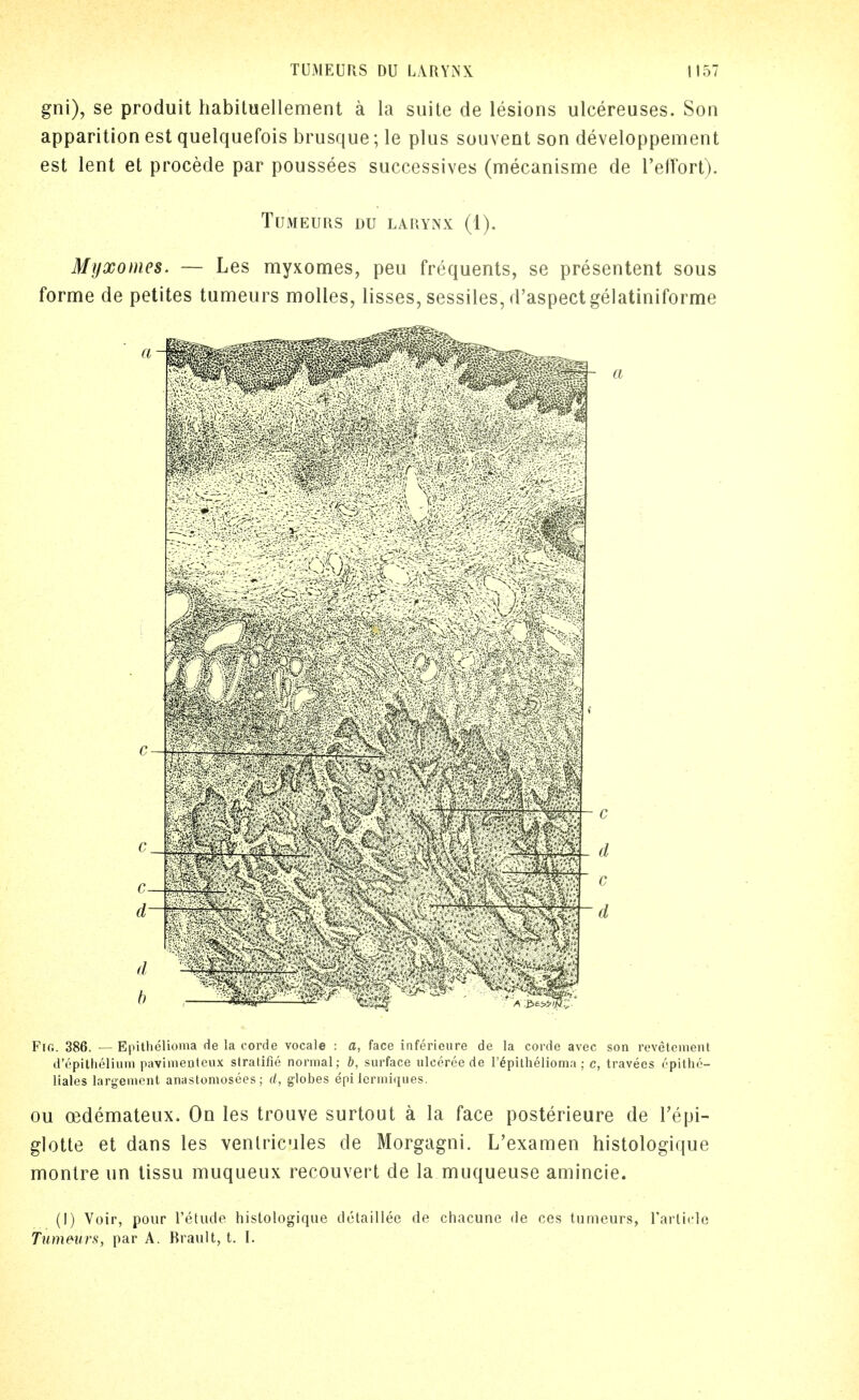 gni), se produit habituellemenl a la suite de lesions ulcereuses. Son apparition est quelquefois brusque; le plus souvent son developpement est lent et procede par poussees successives (mecanisme de Teffort). TUMEURS DU LARYNX (1). Mijxomes. — Les myxomes, peu frequents, se presentent sous forme de petites tumeurs moUes, lisses, sessiles, d'aspectgelatiniforme Fig. 386. —Epithelioma de la corde vocale : a, face inferieure de la corde avec son revetenient d'epilheliuni paviiiieiiteux stratifie normal; b, surface ulceree de I'^pilhelioma ; c, travees opitho- liales largemcnt anastomosees ; (/, globes epi Icrmiciiies. ou ffidemateux. On les trouve surtout a la face posterieure de Tepi- glotte et dans les venlricules de Morgagni. L'examen histologique montre un tissu muqueux recouvert de la muqueuse amincie. (I) Voir, pour Tetude histologique dctaillee de chacune de ces tumeurs, rarticle Tumeurs, par A, Brault, t. I.