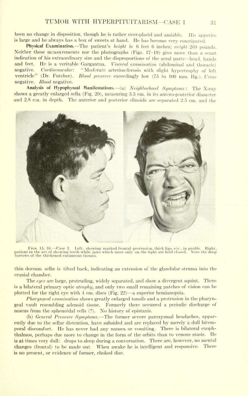 been no change in disposition, though he is rather over-placid and amiable. His appetite is large and he always has a box of sweets at hand. He has become very constipated. Physical Examination.—The patient's height is 6 feet 6 inches; iveight 269 pounds. Neither these msasurements nor the photographs (Figs. 17-19) give more than a scant indication of his extraordinary size and the disproportions of the acral parts—head, hands and feet. He is a veritable Gargantua. Visceral examination (abdominal and thoracic) negative. Cardiovascular: Moderate arteriosclerosis with slight hypertrophy of left ventricle (Dr. Futcher). Blood pressure exceedingly low (75 to 100 mm. Hg.). Urine negative. Blood negative. Analysis of Hypophyseal Manifestations.—(a) Neighborhood Symptoms: The X-ray shows a greatly enlarged sella (Fig. 20), measuring 3.5 cm. in its antero-posterior diameter and 2.8 cm. in depth. The anterior and posterior clinoids are separated 2.5 cm. and the Figs. 15, 16.—Case I. Left, showing marked frontal protrusion, thick lips, etc., in profile. Right, patient in the act of showing teeth while jaws which meet only on the right are held closed. Note the deep furrows of the thickened cutaneous tissues. thin dorsum sellse is tilted back, indicating an extension of the glandular struma into the cranial chamber. The eyes are large, protruding, widely separated, and show a divergent squint. There is a bilateral primarj^ optic atrophy, and only two small remaining patches of vision can be plotted for the right eye with 4 cm. discs (Fig. 22)—a superior hemianopsia. Pharyngeal examination shows greatly enlarged tonsils and a protrusion in the pharyn- geal vault resembling adenoid tissue. Formerly there occurred a periodic discharge of mucus from the sphenoidal cells (?). No history of epistaxis. (b) General Pressure Symptoms.—The former severe paroxysmal headaches, appar- ently due to the sellar distention, have subsided and are replaced by merely a dull bitem- poral discomfort. He has never had any nausea or vomiting. There is bilateral exoph- thalmos, perhaps due more to change in the form of the orbits than to venous stasis. He is at times very dull: drops to sleep during a conversation. There are, however, no mental changes (frontal) to be made out. When awake he is intelligent and responsive. There is no present, or evidence of former, choked disc.