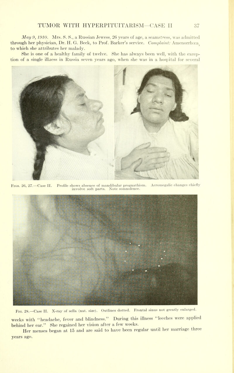 May 9, 1910. Mrs. S. S., a Russian Jewess, 26 years of age, a seamstress, was admitted through her physician, Dr. H. G. Beck, to Prof. Barker's service. Coviplainl: Amenorrhoea to which she attributes her malady. She is one of a healthy family of twelve. She has always been well, with the excep- tion of a single illness in Russia seven years ago, when she was in a hospital for several Figs. 26, 27.—Case II. Profile shows absence of mandibular prognathism. Acromegalic changes chiefly involve soft parts. Note somnolence. Fig. 28.—Case II. X-ray of sella (nat. size). Outlines dotted. Frontal sinus not greatly enlarged. weeks with headache, fever and blindness. During this illness leeches were appHed behind her ear. She regained her vision after a few weeks. Her menses began at 15 and are said to have been regular until her marriage three years ago.