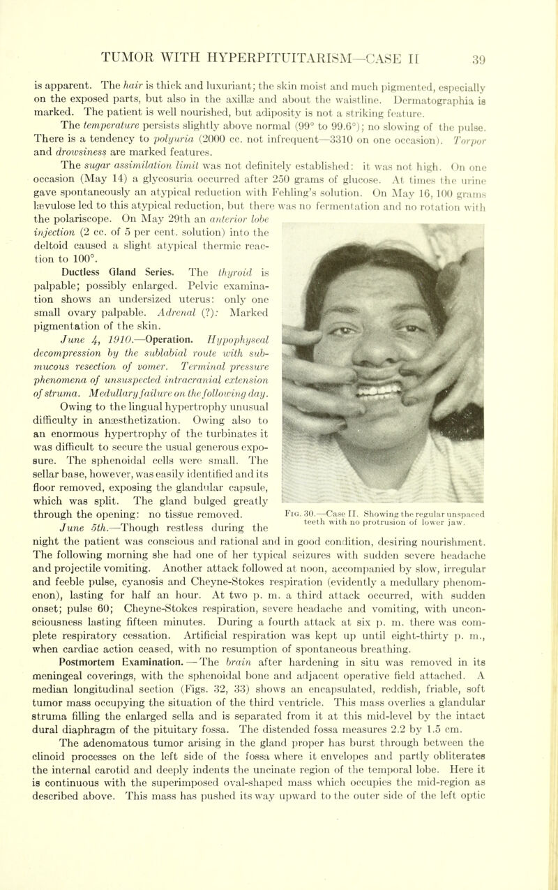 is apparent. The hair is thick and luxuriant; the skin moist and much pigmented, especially on the exposed parts, but also in the axillas and about the waistline. Dcrmatographia is marked. The patient is well nourished, but adiposity is not a striking feature. The temperature persists shghtly above normal (99° to 99.6°); no slowing of the pulse. There is a tendency to polyuria (2000 cc. not infrequent—3310 on one occasion). Torpor and drowsiness are marked features. The sugar assiniilatiou limit was not definitely established: it was not high. On one occasion (May 14) a glycosuria occurred after 250 grams of glucose. At times the urine gave spontaneously an atypical reduction with Fehling's solution. On May 16, 100 grams Isevulose led to this atypical reduction, but there was no fermentation and no rotation with the polariscope. On May 29th an anterior lobe injection (2 cc. of 5 per cent, solution) into the deltoid caused a slight atypical thermic reac- tion to 100°. Ductless Gland Series. The thyroid is palpable; possibly enlarged. Pelvic examina- tion shows an undersized uterus: only one small ovary palpable. Adrenal (?); Marked pigmentation of the skin. June 4, 1910.—Operation. Hypophyseal decompression hy the suhlabial route with sub- mucous resection of vomer. Terminal pressure phenomena of unsuspected intracranial extension of struma. Medullary failure on the following day. Owing to the lingual hypertrophy unusual difficulty in angesthetization. Owing also to an enormous hypertrophy of the turbinates it was difficult to secure the usual generous expo- sure. The sphenoidal cells were small. The sellar base, however, was easily identified and its floor removed, exposing the glandular capsule, which was split. The gland bulged greatly through the opening: no tissue removed. Fig. 30.—Case II. Showing the regular unspaced T ^,7 rrn 1 ,1 1 • ,1 teeth with no protrusion of lower jaw. June dth.—Though restless durmg the night the patient was conscious and rational and in good condition, desiring nourishment. The following morning she had one of her typical seizures with sudden severe headache and projectile vomiting. Another attack followed at noon, accompanied by slow, irregular and feeble pulse, cyanosis and Cheyne-Stokes respiration (evidently a medullary phenom- enon), lasting for half an hour. At two p. m. a third attack occurred, with sudden onset; pulse 60; Cheyne-Stokes respiration, severe headache and vomiting, with uncon- sciousness lasting fifteen minutes. During a fourth attack at six p. m. there was com- plete respiratory cessation. Artificial respiration was kept up until eight-thirty p. m., when cardiac action ceased, with no resumption of spontaneous breathing. Postmortem Examination. — The brain after hardening in situ was removed in its meningeal coverings, with the sphenoidal bone and adjacent operative field attached. A median longitudinal section (Figs. 32, 33) shows an encapsulated, reddish, friable, soft tumor mass occupying the situation of the third ventricle. This mass overlies a glandular struma filling the enlarged sella and is separated from it at this mid-level by the intact dural diaphragm of the pituitary fossa. The distended fossa measures 2.2 by 1.5 cm. The adenomatous tumor arising in the gland proper has burst through between the clinoid processes on the left side of the fossa where it envelopes and partly obliterates the internal carotid and deeply indents the uncinate region of the temporal lobe. Here it is continuous with the superimposed oval-shaped mass which occupies the mid-region as described above. This mass has pushed its way upward to the outer side of the left optic