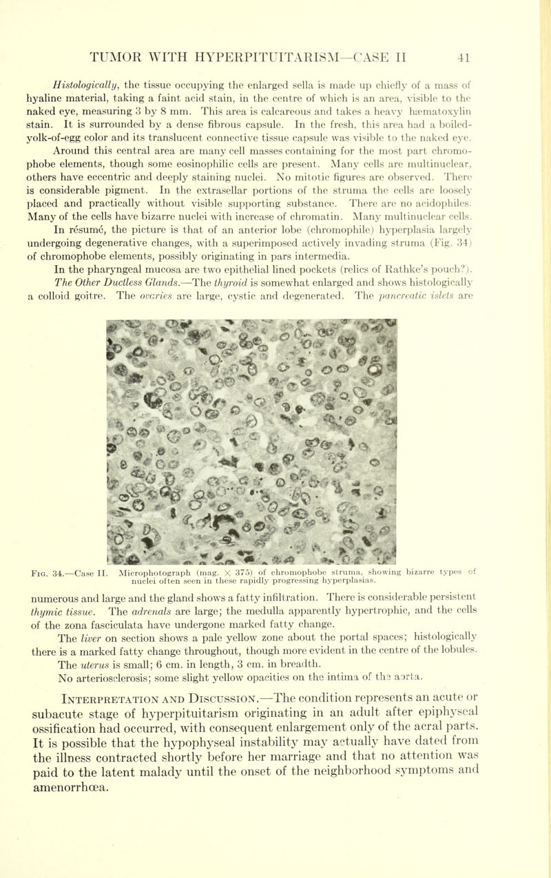 Histologically, the tissue occupying the enlarged sella is made up chiefly of a mass of hyaline material, taking a faint acid stain, in the centre of which is an area, visible to the naked eye, measuring 3 by 8 mm. This area is calcareous and takes a heavy hirmatoxylin stain. It is surrounded by a dense fibrous capsule. In the fresh, this area had a boiled- yolk-of-egg color and its translucent connective tissue capsule was visible to the naked eye. Around this central area are many cell masses containing for the most part chromo- phobe elements, though some eosinophilic cells are present. Many cells are multinuclear, others have eccentric and deeply staining nuclei. No mitotic figures are observed. There is considerable pigment. In the extrasellar portions of the struma the cells are loosely placed and practically without visible supporting substance. There are no acidophiles. Many of the cells have bizarre nuclei with increase of chromatin. Many multinuclear cells. In resume, the picture is that of an anterior lobe (chromophile) hyperplasia largely undergoing degenerative changes, with a superimposed actively invading struma (Fig. 34) of chromophobe elements, possibly originating in pars intermedia. In the pharyngeal mucosa are two epithelial lined pockets (relics of Rathke's pouch?). The Other Ductless Glands.—The thyroid is somewhat enlarged and shows histologically a colloid goitre. The ovaries are large, cystic and degenerated. The pancreatic islets are Fig. 34.—Case II. Microphotograph (mag. X 375) of chromophobe atruma, showing bizarre types of nuclei often seen in these rapidly progressing hyperplasias. numerous and large and the gland shows a fatty infiltration. There is considerable persistent thymic tissue. The adrenals are large; the medulla apparently hypertrophic, and the cells of the zona fasciculata have undergone marked fatty change. The liver on section shows a pale yellow zone about the portal spaces; histologically there is a marked fatty change throughout, though more evident in the centre of the lobules. The uterus is small; 6 cm. in length, 3 cm. in breadth. No arteriosclerosis; some slight yellow opacities on the intima of ths aarta. Interpretation and Discussion.—The condition represents an acute or subacute stage of hyperpituitarism originating in an adult after epiphyseal ossification had occurred, with consequent enlargement only of the acral parts. It is possible that the hypophyseal instability may actually have dated from the illness contracted shortly before her marriage and that no attention was paid to the latent malady until the onset of the neighborhood symptoms and amenorrhoea.