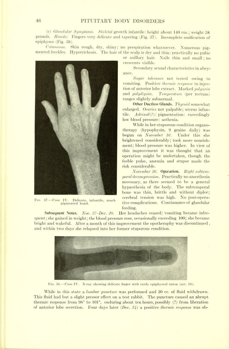 (c) Glandular Symptoms. Skeletql growth infantile: height about 140 cm.; weight 58 pounds. Hands: Fingers very dehcate and tapering (Pig. 37). In('()nii)lete ossification of epiphyses (Fig. 38). Cuta?ieous. Skin rough, dry, shiny; no perspiration whatsoever. Numerous i)ig- mented freckles. Hypotrichosis. The hair of the scalp is dry and thin: practically no pubic or axillary hair. Nails thin and small ; no crescents visible. Secondary sexual characteristics in abey- ance. Sugar tolerance not tested owing to vomiting. Positive thermic response to injec- tion of anterior lobe extract. Marked polyuria and polydipsia. Temperature (per rectum) ranges slightly subnormal. Other Ductless Glands. Thyroid somewhat enlarged. Ovaries not palpable; uterus infan- tile. Adrenal{?): pigmentation: exceedingly low blood pressure: asthenia. While in her stuporous condition organo- therapy (hypophysin, 9 grains daily) was begun on November 16. Under this she brightened considerably; took more nourish- ment; blood pressure w^as higher. In view of this improvement it w^as thought that an operation might be undertaken, though the feeble pulse, anaemia and stupor made the risk considerable. November 26. Operation. Right subtem- poral flecompression. Practically no anaesthesia necessary, as there seemed to be a general hypsesthesia of the body. The subtemporal bone was thin, brittle and without diploe; cerebral tension was high. No post-opera- tive complications. Continuance of glandular feeding. Her headaches ceased; vomiting became infre- quent; she gained in w^eight; the blood pressure rose, occasionally exceeding 100; she became bright and wakeful. After a month of this improvement the opotheraphy was discontinued , and within two days she relapsed into her former stuporous condition. Fig. 37. -Case IV. Delicate, infantile, pigmented hand. much Subsequent Notes. Nov. 27-Dec. 20. Fig. 38 X-ray showing deUcate finger with tardy epiphyseal uni 18). While in this state a lumbar puncture was performed and 30 cc. of fluid withdrawn. This fluid had but a slight pressor effect on a test rabbit. The puncture caused an abrupt thermic response from 98° to 101°, enduring about ten hours, possibly (?) from liberation of anterior lobe secretion. Four days later {Dec. 24) a positive thermic response was ob-