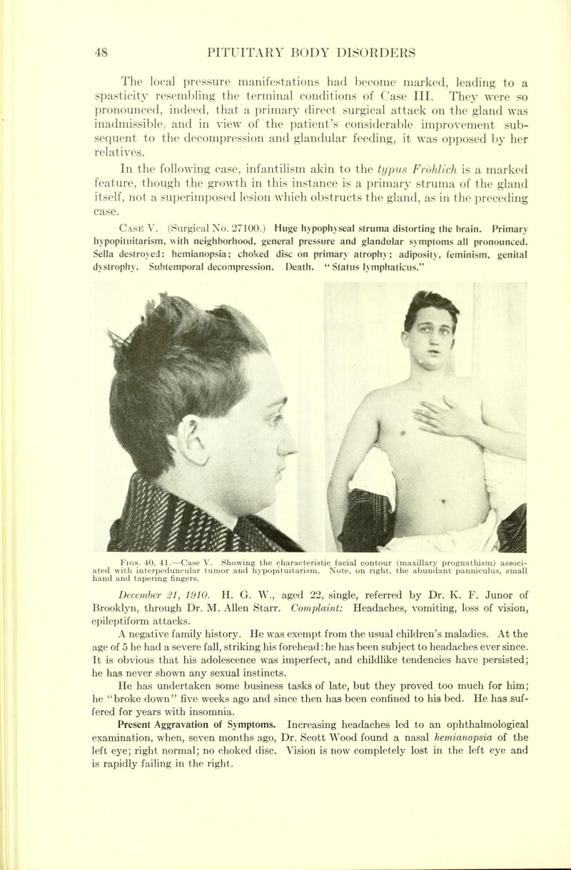 The local pressure manifestations had become marked, leadin<>; to a spasticity resembling the terminal conditions of Case III. They were so pronounced, indeed, that a primary direct surgical attack on the gland was inadmissible; and in view of the patient's considerable improvement sub- sequent to the decompression and glandular feeding, it was opposed by her relatives. In the following case, infantilism akin to the typus Frohlich is a marked feature, though the growth in this instance is a primary struma of the gland itself, not a superimposed lesion which obstructs the gland, as in the preceding case. Case V. (Surgical No. 27100.) Huge hy pophyseal struma distorting the brain. Primary hypopituitarism, \\\t\\ neighborhood, general pressure and glandular S} mptoms all pronounced. Sella destroyed: hemianopsia; choked disc on primary atroph\; adiposit}, feminism, genital dystrophy. Subtemporal decompression. Death.  Status lymphaticus. Figs. 40, 41.—Case V. Showing the characteristic facial contour (maxillary prognathism) associ- ated with interpeduncular tumor and hypopituitarism. Note, on right, the abundant panniculus, small hand and tapering fingers. December 21, 1910. H. G. W., aged 22, single, referred by Dr. K. F. Junor of Brooklyn, through Dr. M. Allen Starr. Complaint: Headaches, vomiting, loss of vision, epileptiform attacks. A negative family history. He was exempt from the usual children's maladies. At the age of 5 he had a severe fall, striking his forehead: he has been subject to headaches ever since. It is obvious that his adolescence was imperfect, and childlike tendencies have persisted; he has never shown any sexual instincts. He has undertaken some business tasks of late, but they proved too much for him; he ''broke down five weeks ago and since then has been confined to his bed. He has suf- fered for years with insomnia. Present Aggravation of Symptoms. Increasing headaches led to an ophthalmological examination, when, seven months ago. Dr. Scott Wood found a nasal hemianopsia of the left eye; right normal; no choked disc. Vision is now completely lost in the left eye and is rapidly failing in the right.