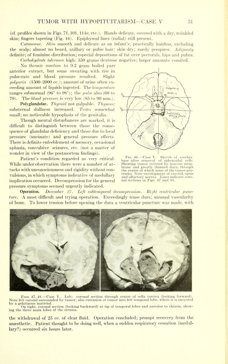 (cf. profiles shown in Figs. 71,101, 114a, etc.). Hands delicate, covered with a dry, wrinkled skin; fingers tapering (Fig. 44). Epiphyseal lines (radial) still present. Cutaneous. Skin smooth and delicate as an infant's; practically hairless, excluding the scalp; almost no beard, axillary or pubic hair: skin dry; rarely perspires. Adiposity definite; of feminine distribution; especial depositions of fat over pectorals, hips and pubes. Carbohydrate tolerance high: 350 grams dextrose negative; larger amounts vomited. No therrnic reaction to 0.2 gram boiled pars anterior extract, but some sweating with rise in pulse-rate and blood pressure resulted. Slight polyuria (1500-2000 cc.); amount of urine often ex- ceeding amount of liquids ingested. The te^nperature ranges subnormal (96° to 98°); the pulse also (60 to 70). The blood pressure is very low (85 to 90 mm.). Polyglandular. Thyroid not palpable. Thymus: substernal dullness increased. Testes somewhat small; no noticeable hypoplasia of the genitalia. Though mental disturbances are marked, it is difficult to distinguish between those the conse- quence of glandular deficiency and those due to local pressure (uncinate) and general pressure effects. There is definite enfeeblement of memory, occasional aphasia, convulsive seizures, etc. (not a matter of wonder in view of the postmortem findings). Patient's condition regarded as very critical. While under observation there were a number of at- tacks with unconsciousness and rigidity without con- vulsions, in which symptoms indicative of medullary implication occurred. Decompression for the general pressure symptoms seemed urgently indicated. Operation. December 27. Left subtemporal decompression. Rijht ventricular punc- ture. A most difficult and trying operation. Exceedingly tense dura; unusual vascularity of bone. To lower tension before opening the dura a ventricular puncture was made, with Sketch cerebra Fig. 46.—Case V. base after removal of sphenoidal cells. Showing tumor covered by mucous mem- brane and greatly thinned dura, through the centre of which some of the tumor pro- trudes. Note envelopment of carotid, optic and olfactory nerves. Lines indicate coro- nal sections in Figs. 47 and 48. Figs. 47, 48.—Case V. Left: coronal section through centre of sella turcica (looking forward). Note left carotid surrounded by tumor; also extension of tumor into left temporal lobe, where it is encysted by a gelatinous material. On right, coronal section (looking backward) at tip of temporal lobes and anterior to chiasm, show- ing the three main lobes of the struma. the withdrawal of 25 cc. of clear fluid. Operation concluded; prompt recovery from the anaesthetic. Patient thought to be doing well, when a sudden respiratory cessation (medul- lary?) occurred six hours later.