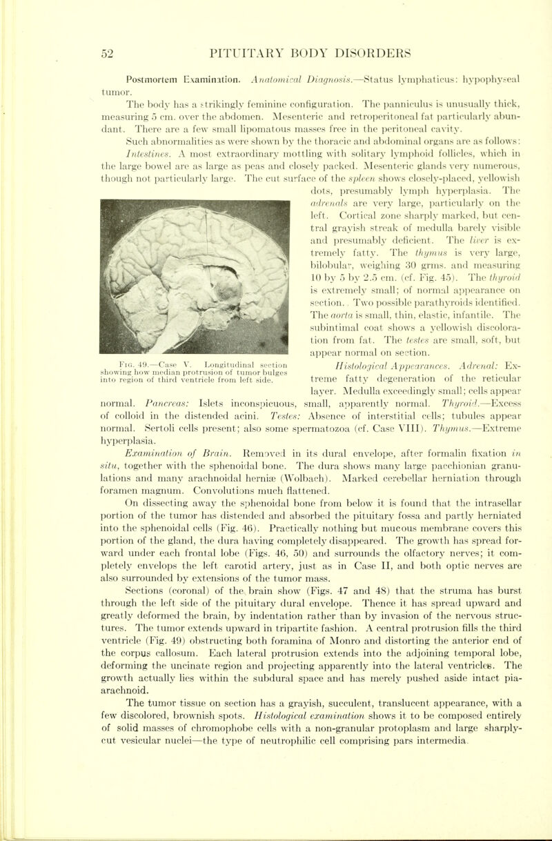 Postmortem Examination. AtKiloinit-nl Diiujuosis.—Status lyiii])liatim-: liypoplivMvil tumor. The body has a strikingly feminine eonfigiu-ation. 'I'hc panniciilu-- i- iiinisiiall>- thick, measm'ing 5 cm. over the abdomen. Mesenteric and retroperitoneal fat part i( ulari>-ahmi- dant. There are a few small lipomatous masses free in the peritoneal ('a\ it>-. Such abnormalities as were shown by the thoracic and abtlominal organs are as follows; Intestines. A most extraordinary mottling with solitary lymphoid follicles, which in the large bowel are as large as peas and closely packed. Mesenteric glands ver>- luunerous. though not particularly large. The cut surface of the spleen shows closely-placed, yellowish dots, presumably lymi)h hyperplasia. The (iilrcndls are very large, particularly on the left. Cortical zone sharpl}' marked, but cen- tral grayish streak of medulla barel}' visible and i:)resumabl3^ deficient. The liver is ex- tremely fatty. The thymus is very large, bilobular, weighing 30 grms. and mea.suring 10 by 5 by 2.5 cm. (cf. Fig. 45). The Ihi/roid is extremely small; of normal appearance on section.. Two possible parathyroids identified. The aorta is small, thin, elastic, infantile. The subintimal coat shows a yellowish discolora- tion from fat. The testes are small, soft, but appear normal on section. Fig 49.—Case V. Longitudinal section Histological Avvearauces. Adrenal: Ex- showmg now median protrusion of tumor bulges c '^ • r ^ • i into region of third ventricle from left side. treme fatty degeneration of the reticular layer. Medulla exceedingly small; cells appear normal. Pancreas: Islets inconspicuous, small, apparently normal. Thyroid.—Excess of colloid in the distended acini. Testes: Absence of interstitial cells; tubules appear normal. Sertoli cells present; also some spermatozoa (cf. Case VIII). Thymus.—Extreme hyperplasia. Examination of Brain. Removed in its dural envelope, after formalin fixation in situ, together with the sphenoidal bone. The dura shows many large pacchionian granu- lations and many arachnoidal hernise (Wolbach). Marked cerebellar herniation through foramen magnum. Convolutions much flattened. On dissecting away the sphenoidal bone from below it is found that the intrasellar portion of the tumor has distended and absorbed the pituitary fossa and partly herniated into the sphenoidal cells (Fig. 46). Practically nothing but mucous membrane covers this portion of the gland, the dura having completely disappeared. The growth has spread for- ward under each frontal lobe (Figs. 46, 50) and surrounds the olfactory nerves; it com- pletely envelops the left carotid artery, just as in Case II, and both optic nerves are also surrounded by extensions of the tumor mass. Sections (coronal) of the, brain show (Figs. 47 and 48) that the struma has burst through the left side of the pituitary dural envelope. Thence it has spread upward and greatly deformed the brain, by indentation rather than by invasion of the nervous struc- tures. The tumor extends upward in tripartite fashion. A central protrusion fills the third ventricle (Fig. 49) obstructing both foramina of Monro and distorting the anterior end of the corpus callosum. Each lateral protrusion extends into the adjoining temporal lobe, deforming the uncinate region and projecting apparently into the lateral ventricles. The growth actually lies within the subdural space and has merely pushed aside intact pia- arachnoid. The tumor tissue on section has a grayish, succulent, translucent appearance, with a few discolored, brownish spots. Histological examination shows it to be composed entirely of solid masses of chromophobe cells with a non-granular protoplasm and large sharply- cut vesicular nuclei—the type of neutrophilic cell comprising pars intermedia.