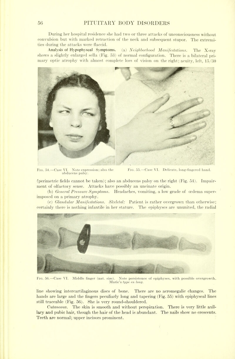 During her hosi)ital residence she had two or three attacks of unconsciousness without convulsion but with marked retraction of the neck and subsequent stupor. The extremi- ties during the attacks were flaccid. Analysis of Hypophyseal Symptoms. (a) Neighborhood Manifestations. I1ie X-ray shows a shghtly enlarged sella (Fig. 53) of normal configuration. There is a l)ilat('ral pri- mary optic atrophy with almost complete loss of vision on the right; acuity, left, lo/;}() Fig. 54.—Case VI. Note expression; also ilic abducens palsy. Fig. -Case VI. Delicate, l.,iiy-finij:( (perimetric fields cannot be taken); also an abducens palsy on the right (Fig. 54). Impair- ment of olfactory sense. Attacks have possibly an uncinate origin. (b) General Pressure Sympto?ns. Headaches, vomiting, a low grade of oedema super- imposed on a primary atrophy. (c) Glandular Manifestations. Skeletal: Patient is rather overgrown than otherwise; certainly there is nothing infantile in her stature. The epiphyses are ununited, the radial Ca.se VI. Middle finger (nat. size). Note persistence of epiphyses, with possible overgrowth. Marie's type en long. line showing intercartilaginous discs of bone. There are no acromegalic changes. The hands are large and the fingers peculiarly long and tapering (Fig. 55) with epiphyseal lines still traceable (Fig. 56). She is very round-shouldered. Cutaneous. The skin is smooth and without perspiration. There is very little axil- lary and pubic hair, though the hair of the head is abundant. The nails show no crescents. Teeth are normal; upper incisors prominent.