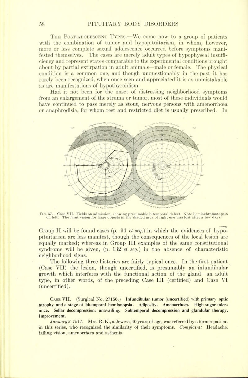 The Post-adolescent Types.—We come now to a group of patients with the combination of tumor and hypo])ituitarism, in whom, however, more or less complete sexual adolescence occurred before s3'mptoms mani- fested themselves. The cases are merely adult types of hj-pophyseal insuffi- ciency and represent states comparable to the experimental conditions brought about by partial extirpation in adult animals—male or female. The i)hysical condition is a common one, and though unquestionably in the past it has rarely been recognized, when once seen and appreciated it is as unmistakable as are manifestations of hypothyroidism. Had it not been for the onset of distressing neighborhood symptoms from an enlargement of the struma or tumor, most of these individuals would have continued to pass merely as stout, nervous persons with amenorrhoea or anaphrodisia, for whom rest and restricted diet is usually prescribed. In Fig. 57.—Case VII. Fields on admission, showing presumable bitemporal defect. Note hemiachromatopsia on left. The faint vision for large objects in the shaded area of right eye was lost after a few days. Group II win be found cases (p. 94 et seq.) in which the evidences of hypo- pituitarism are less manifest, though the consequences of the local lesion are equally marked; whereas in Group III examples of the same constitutional syndrome will be given, (p. 132 et seq.) in the absence of characteristic neighborhood signs. The following three histories are fairly typical ones. In the first patient (Case VII) the lesion, though uncertified, is presumably an infundibular growth which interferes with the functional action of the gland—an adult type, in other words, of the preceding Case III (certified) and Case VI (uncertified). Case VII. (Surgical No. 27156.) Infundibular tumor (uncertified) with primary optic atrophy and a stage of bitemporal hemianopsia. Adiposity. Amenorrhoea. High sugar toler= ance. Sellar decompression: unavailing. Subtemporal decompression and glandular therapy. Improvement. January 2,1911. Mrs. R. K,, a Jewess, 40 years of age, was referred by a former patient in this series, who recognized the similarity of their symptoms. Complaint: Headache, failing vision, amenorrhoea and asthenia.