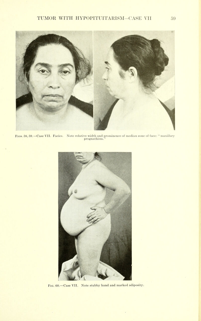 Figs. 58, 59.—Case VII. Facies. Note relative width and prominence of median zone of face:  maxillarj' prognathism. Fig. 60.—Case VII. Note stubby hand and marked adiposity.