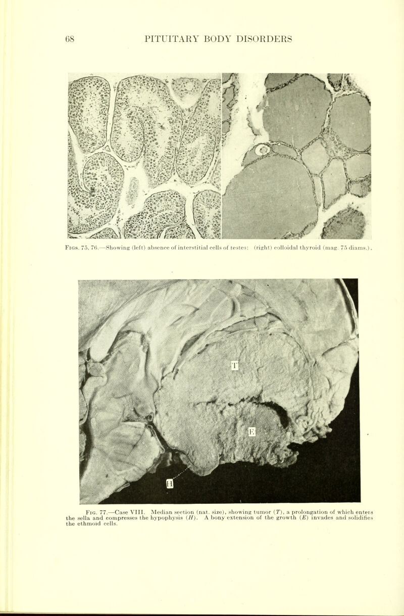 Fig. 77.—Case VIII. Median section (nat. size), showing tumor (T), a prolongation of which enteis the sella and compresses the hypophysis (H). A bony extension of the growth (E) invades and solidifies the ethmoid cells.