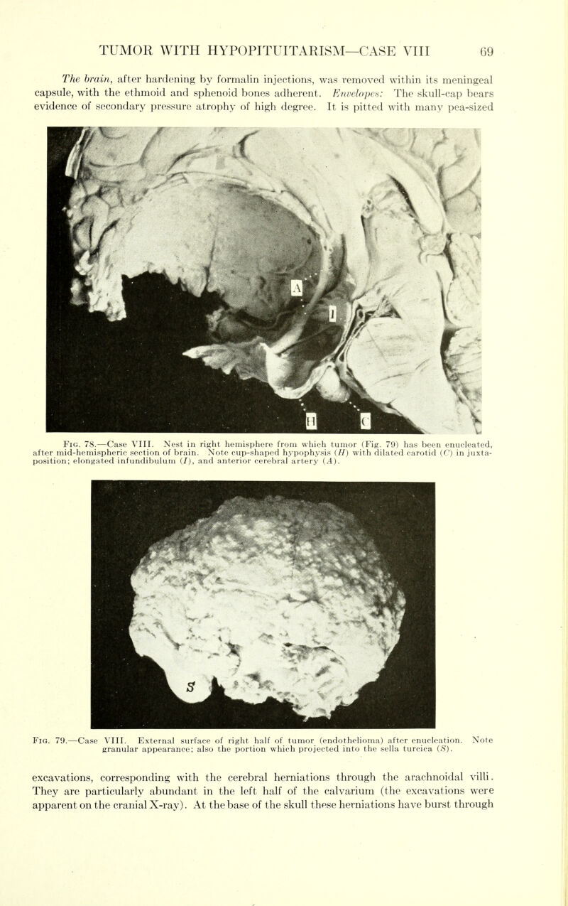 The brain, after hardening by formalin injections, was removed within its meningeal capsule, with the ethmoid and sphenoid bones adherent. Envelopes: The skull-cap bears evidence of secondary pressure atrophy of high degree. It is pitted with many pea-sized Fig. 78.—Case VIII. Nest in right hemisphere from which tumor (Fig. 79) has been enucleated, after mid-hemispheric section of brain. Note cup-shaped hypophysis (H) with dilated carotid (C) in juxta- position; elongated infundibulum {/), and anterior cerebral artery (A). Fig. 79.- -Case VIII. External surface of right half of tumor (endothelioma) after enucleation, granular appearance; also the portion which projected into the sella turcica (<S). Note excavations, corresponding with the cerebral herniations through the arachnoidal villi. They are particularly abundant in the left half of the calvarium (the excavations were apparent on the cranial X-ray). At the base of the skull these herniations have burst through