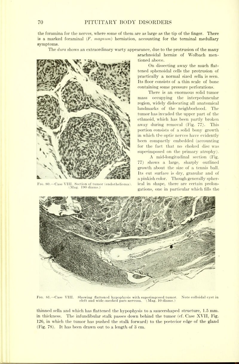 the foramina for the nerves, where some of them are as large as the tip of the finger. There is a marked foraminal {F. magnum) herniation, accounting for the terminal medullary symptoms. The dura shows an extraordinary warty appearance, due to the protrusion of the many arachnoidal hornicp of Wolbach men- tioned above. On dissecting away the much flat- tened si)henoidal cells the protrusion of practically a normal sized sella is seen. Its floor consists of a thin scale of bone containing some pressure perforations. There is an enormous solid tumor mass occupying the interpeduncular region, widely dislocating all anatomical landmarks of the neighborhood. The tumor has invaded the upper part of the ethmoid, which has been partly broken away during removal (Fig. 77). This portion consists of a solid bony growth in which the optic nerves have evidently been compactly embedded (accounting for the fact that no choked disc was superimposed on the primary atrophy). A mid-longitudinal section (Fig. 77) shows a large, sharply outlined growth about the size of a tennis ball. Its cut surface is dry, granular and of a pinkish color. Though generally spher- ical in shape, there are certain prolon- gations, one in particular which fills the Fig. 80.—Case VIII. Section of tumor (endothelioma: (Mag. 190 diams.) Fig. 81.—Case VIII. Showing flattened hypophy.sis with superimpo.sed tumor, cleft and wide-meshed pars nervosa. (Mag. 10 diams.) Note colloidal cyst in thinned sella and which has flattened the hypophysis to a saucershaped structure, 1.5 mm. in thickness. The infundibular stalk passes down behind the tumor (cf. Case XVII, Fig. 126, in which the tumor has pushed the stalk forward) to the posterior edge of the gland (Fig. 78). It has been drawn out to a length of 3 cm.