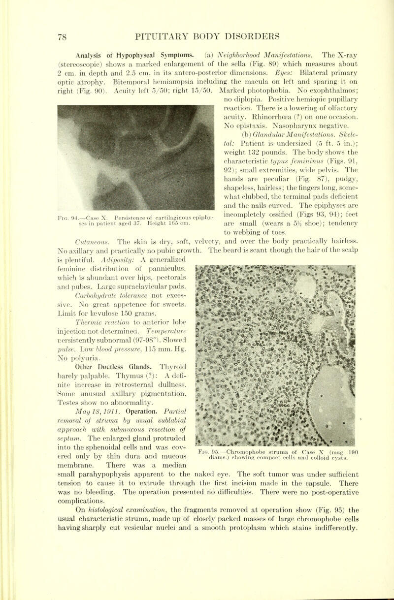 Fig. 94.—Case X. Persistence of cartilaginous epiphv ses in patient aged 37. Height 165 cm. Analysis of Hypophyseal Symptoms. (a) Neighborhood Manifestations. The X-ray (stereoscopic) shows a marked enlargement of the sella (Fig. 89) which measures about 2 cm. in depth and 2.5 cm. in its antero-posterior dimensions. Eyes: Bilateral primary optic atrophy. Bitemporal hemianopsia including the macula on left and sparing it on right (Fig. 90). Acuity left 5/50; right 15/50. Marked photophobia. No exophthalmos; no diplopia. Positive hemiopic i)U]3illary reaction. There is a lowering of olfactory acuity. Rhinorrha^a (?) on one occasion. No epistaxis. Nasopharj^nx negative. (b) Glandular Manifestations. Skele- tal: Patient is undersized (5 ft. 5 in.); weight 132 pounds. The body shows the characteristic typus femininus (Figs. 91, 92); small extremities, wide pelvis. The hands are pecuhar (Fig. 87), pudgy, shapeless, hairless; the fingers long, some- what clubbed, the terminal pads deficient and the nails curved. The epiphyses are incompletely ossified (Figs 93, 94); feet are small (wears a 5>2 shoe); tendency to webbing of toes. Cutaneous. The skin is dry, soft, velvety, and over the body practically hairless. No axillary and practically no pubic growth. The beard is scant though the hair of the scalp is plentiful. Adiposity: A generalized feminine distribution of panniculus, V'^j^^jiil'^^Tf ** ^**V which is abundant over hips, pectorals and pubes. Large supraclavicular pads. Carbohydrate tolerance not exces- sive. No great appetence for sweets. Limit for laevulose 150 grams. Thermic reaction to anterior lobe injection not determined. Temperature persistently subnormal (97-98°). Slowed pulse. Low blood pressure, 115 mm. Hg. No polyuria. Other Ductless Glands. Thyroid barely palpable. Thymus (?): A defi- nite increase in retrosternal dullness. Some unusual axillary pigmentation. Testes show no abnormality. May 18,1911. Operation. Partial removal of struma by usual sublabial approach with submucous resection of septum. The enlarged gland protruded into the sphenoidal cells and was cov- ered only by thin dura and mucous membrane. There was a median small parahypophysis apparent to the naked eye. The soft tumor was under sufficient tension to cause it to extrude through the first incision made in the capsule. There was no bleeding. The operation presented no difficulties. There were no post-operative complications. On histological examination, the fragments removed at operation show (Fig. 95) the usual characteristic struma, made up of closely packed masses of large chromophobe cells having sharply cut vesicular nuclei and a smooth protoplasm which stains indifferently. Fig. 95.—Chromophobe struma of Case X (mag. 190 diams.) showing compact cells and colloid cysts.