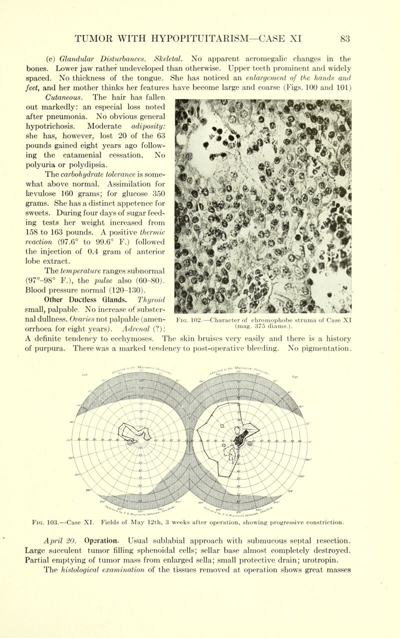 (c) Glandular Disturbances. Skeletal. No apparent acromegalic changes in the bones. Lower jaw rather undeveloped than otherwise. Upper teeth prominent and widely spaced. No thickness of the tongue. She has noticed an enlargement of the hands and feet, and her mother thinks her features have become large and coarse (Figs. 100 and 101) Cutaneous. The hair has fallen out markedly: an especial loss noted after pneumonia. No obvious general hypotrichosis. Moderate adiposity: she has, however, lost 20 of the 63 pounds gained eight years ago follow- ing the catamenial cessation. No polyuria or polydipsia. The carbohydrate tolerance is some- what above normal. Assimilation for Isevulose 160 grams; for glucose 350 grams. She has a distinct appetence for sweets. During four days of sugar feed- ing tests her weight increased from 158 to 163 pounds. A positive thermic reaction (97.6° to 99.6° F.) followed the injection of 0.4 gram of anterior lobe extract. The temperat ure ranges subnormal (97°-98° F.), the pulse also (60-80). Blood pressure normal (120-130). Other Ductless Glands. Thyroid small, palpable. No increase of subster- nal dullness. Ovaries not palpable (amen- orrhoea for eight years). Adrenal (?): A definite tendency to ecchymoses. The skin bruises very easily and there is a history of purpura. There was a marked tendency to post-operative bleeding. No pigmentation. Fig. 103.—Case XI. Fields of May 12th, 3 weeks after operation, showing progressive constriction. April 20. Operation. Usual sablabial approach with submucous septal resection. Large succulent tumor filling sphenoidal cells; sellar base almost completely destroyed. Partial emptying of tumor mass from enlarged sella; small protective drain; urotropin. The histological examination of the tissues removed at operation shows great masses Fig. 102.—Charact. i mI . hnmicphobe struma of Case XI (mag. '.'>( .3 diams.).