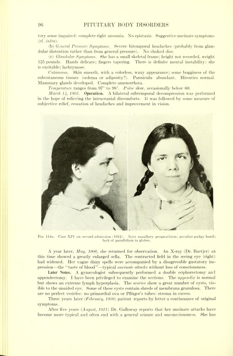 tory sense impaired: complete right anosmia. Xo opistaxis. Suggestivc uncinate symptoms (of. infra). (b) General Pressure Symptoms. Severe bitemporal lieadaciies (prohal)ly from glan- dular distention rather than from general pressure). No choked disc. (c) Glandular Symptoms. She has a small skeletal frame; height not recorded, weight 125 pounds. Hands delicate; fingers tapering. There is definite mental instability: she is excitable; lachrymose. Cutaneous. Skin smooth, with a colorless, waxy appearance; some bogginess of the subcutaneous tissues (oedema or adiposity?). Panniculu abundant. Hirsuties normal. Mammary glands developed. Complete amenorrhoea. Temperature ranges from 97° to 98°. Pulse slow, occasionally below 60. March 14, 1905. Operation. A bilateral subtemporal decompression was performed in the hope of relieving the intracranial discomforts. It was followed by some measin-e of subjective relief, cessation of headaches and improvement in vision. Fig 114a. Case XIV on second admission i 1912 ). Note maxillary prognathism; peculiar pudgy hand; lack of parallelism in globes. A year later, May, 1906, she returned for observation. An X-ray (Dr. Baetjer) at/ this time showed a greatly enlarged sella. The contracted field in the seeing eye (right) had widened. Her vague dizzy spells were accompanied by a disagreeable gustatory im- pression—the taste of blood—typical uncinate attacks without loss of consciousness. Later Notes. A gynaecologist subsequently performed a double oophorectomy and appendectomy. I have been privileged to examine the sections. The appendix is normal but shows an extreme lymph hyperplasia. The ovaries show a great number of cysts, vis- ible to the unaided eye. Some of these cysts contain shreds of membrana granulosa. There are no perfect vesicles: no primordial ova or Pfliiger's tubes: stroma in excess. Three years later (February, 1909) patient reports by letter a continuance of original symptoms. After five years (August, 1911) Dr. Galloway reports that her uncinate attacks have become more typical and often end with a general seizure and unconsciousness. She has