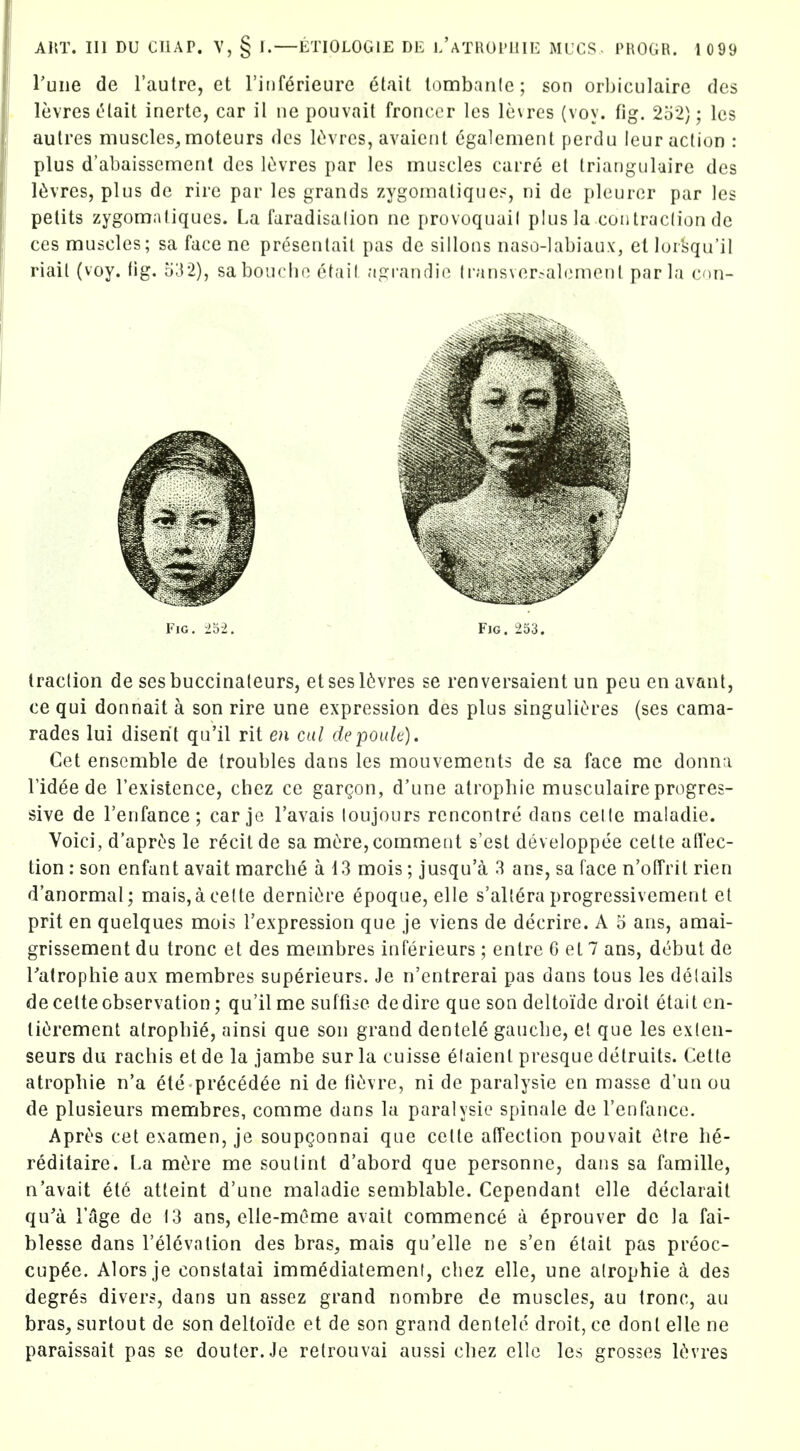 Tune de I'autre, et riiif^rieure elait lombanic; son orbiculaire des levies tUait inertc, car il ne pouvait froncer les le\res (voy. fig. 252); les autres muscles,moteurs des lOivrcs, avaiciit egalemeiit perdu leur action : plus d'abaissement des liivres par les muscles carre el Iriauguluire des l^vres, plus de rire par les grands zygomaliques, ni de pleurer par les petits zygomatiques. La faradisalion ne provoquail plus la contraclion de ces muscles; sa face ne pr^senlail pas de sillons naso-labiau.v, el lor^u'il riail (voy. fig. 532), saboucho etail .-igranrlie lransver^al(}menl par la con- FiG. 252. Fjg. 253. traction de sesbuccinateurs, etsesl6vres se renversaient un peu enavant, ce qui donnait a son rire une expression des plus singuli(>res (ses cama- rades lui diserit qu'il rit en ail depouk). Get ensemble de troubles dans les mouvements de sa face me donna ridee de Texisience, chez ce gargon, d'une atropbie musculaire progres- sive de I'enfance; car je I'avais loujours rencontre dans celte maladie. Voici, d'aprt's le r^cilde sa m(>re,comment s'est developpee cette affec- tion : son enfant avait marche a 13 mois; jusqu'a 3 ans, sa face n'offrit rien d'anormal; mais,ace(te derniOjre epoque, elle s'altera progressivement et prit en quelques mois I'expression que je viens de decrire. A 5 ans, amai- grissement du tronc et des membres inferieurs; entre 6 el 7 ans, debut de Tatrophie aux membres superieurs. Je n'entrerai pas dans tons les details de celte observation; qu'il me suffiie de dire que son deltoide droit elait en- tiCjrement atropbie, ainsi que son grand dentele gauebe, el que les exlen- seurs du rachis et de la jambe sur la cuisse elaient presque detruits. Cette atropbie n'a ete pr6cedee ni de fit!vre, ni de paralysie en masse d'un ou de plusieurs membres, comme dans la paralysie spinale de I'enfance. Aprt's eel examen, je soupgonnai que cetle affection pouvait etre be- reditaire. La mtre me sou tint d'abord que personne, dans sa famille, n'avait etc atteint d'une maladie semblable. Cependant elle declarait qu'a TAge de 13 ans, elle-meme avait commence a eprouver de la fai- blesse dans I'elevation des bras, mais qu'elle ne s'en elait pas preoc- cup6e. Alorsje conslatai immediatemenf, cbez elle, une atrophic a des degr^s divers, dans un assez grand nombre de muscles, au tronc, au bras, surtout de son deltoide et de son grand dentele droit, ce donl elle ne paraissait pas se douter.Je retrouvai aussi cbez elle les grosses liivres