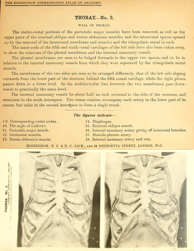 THORAX—No. 3. WALL OF THORAX. The sterno-costal portions of the pectoralis major muscles have been removed, as well as the upper parts of the external oblique and rectus abdominis muscles, and the intercostal spaces opened up by the removal of the intercostal membrane and muscles and the triangularis sterni in each. The inner ends of the fifth and sixth costal cartilages of the left side have also been taken away, to show the relations of the pleural membrane and the internal mammary vessels. The pleural membranes are seen to be bulged forwards in the upper two spaces, and to be in relation to the internal mammary vessels from which they were separated by the triangularis sterni muscle. The membranes of the two sides are seen to be arranged differently, that of the left side sloping outwards from the lower part of the sternum, behind the fifth costal cartilage, while the right pleura passes down to a lower level. In the midclavicular line, however, the two membranes pass down- wards to practically the same level. The internal mammary vessels lie about half an inch external to the side of the sternum, and terminate in the sixth interspace. Two venae comites accompany each artery in the lower part of its course, but unite in the second interspace to form a single trunk. The 1-9. Corresponding costal arches. 14. 10. The angle of Ludovici. 15. 11. Pectoralis major muscle. 16. 12. Intercostal muscles. 17. 13. Rectus abdominis muscle. 18. es indicate— Diaphragm. External oblique muscle. Internal mammary artery giving off intercostal branches. Musculo-phrenic artery. Internal mammary artery and vein.