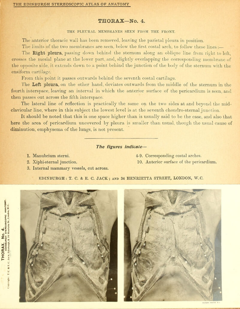 THORAX—No. 4. THE PLEURAL MEMBRANES SEEN FROM THE FRONT. The anterior thoracic wall has been removed, leaving the parietal pleura in position. The limits of the two membranes are seen, below the first costal arch, to folloAv these lines:— The Right pleura, passing down behind the sternum along an oblique line from right to left, crosses the mesial plane at the lower part, and, slightly overlapping the corresponding membrane of the opposite side, it extends down to a point behind the junction of the body of the sternum with the ensiform cartilage. From this point it passes outwards behind the seventh costal cartilage. The Left pleura, on the other hand, deviates outwards from the middle of the sternum in the fourth interspace, leaving an interval in which the anterior surface of the pericardium is seen, and then passes out across the fifth interspace. The lateral line of reflection is practically the same on the two sides at and beyond the mid- clavicular line, where in this subject the lowest level is at the seventh chondro-sternal junction. It should be noted that this is one space higher than is usually said to be the case, and also that here the area of pericardium uncovered by pleura is smaller than usual, though the usual cause of diminution, emphysema of the lungs, is not present. The figures indicate— 1. Manubrium sterni. 4-9. Corresponding costal arches. 2. Xiphi-sternal junction. 10. Anterior surface of the pericardium. 3. Internal mammary vessels, cut across.