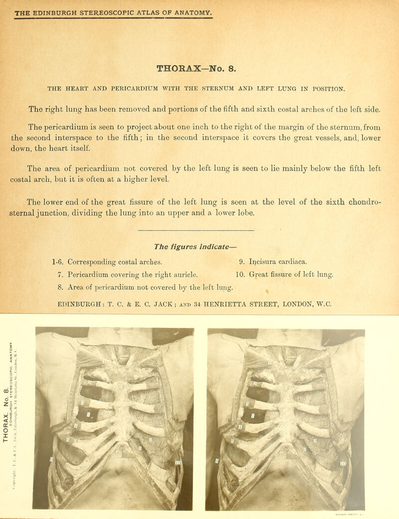 THORAX—No. 8. THE HEART AND PERICARDIUM WITH THE STERNUM AND LEFT LUNG IN POSITION. The right lung has been removed and portions of the fifth and sixth costal arches of the left side. The pericardium is seen to project about one inch to the right of the margin of the sternum, from the second interspace to the fifth; in the second interspace it covers the great vessels, and, lower down, the heart itself. The area of pericardium not covered by the left lung is seen to lie mainly below the fifth left costal arch, but it is often at a higher level. The lower end of the great fissure of the left lung is seen at the level of the sixth chondro- sternal junction, dividing the lung into an upper and a lower lobe. The figures indicate— 1-6. Corresponding costal arches. 7. Pericardium covering the right auricle. 8. Area of pericardium not covered by the left lung. 9. Incisura cardiaca. 10. Great fissure of left lung.