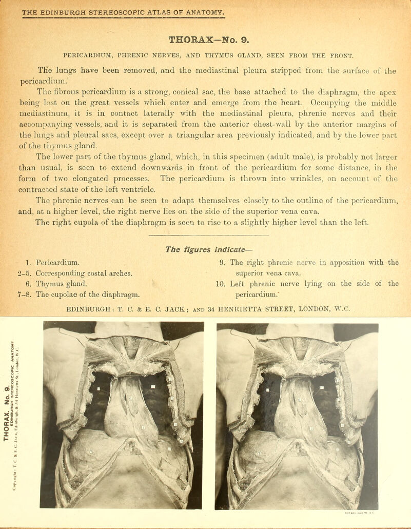 THORAX—No. 9. PERICARDIUM, PHRENIC NERVES, AND THYMUS GLAND, SEEN FROM THE FRONT. TKe lungs have been removed, and the mediastinal pleura stripped from the surface of the pericardium.' The fibrous pericardium is a strong, conical sac, the base attached to the diaphragm, the apex being lost on the great vessels which enter and emerge from the heart. Occupying the middle mediastinum, it is in contact laterally with the mediastinal pleura, phrenic nerves and their accompanying vessels, and it is separated from the anterior chest-wall by the anterior margins of the lungs and pleural sacs, except over a triangular area previously indicated, and by the lower part of the thymus gland. The lower part of the thymus gland, which, in this specimen (adult male), is probably not larger than usual, is seen to extend downwards in front of the pericardium for some distance, in the form of two elongated processes. The pericardium is thrown into wrinkles, on account of the contracted state of the left ventricle. The phrenic nerves can be seen to adapt themselves closely to the outline of the pericardium, and, at a higher level, the right nerve lies on the side of the superior vena cava. The right cupola of the diaphragm is seen to rise to a slightly higher level than the left. The figures indicate— 1. Pericardium. 2-5. Corresponding costal arches. 6. Thymus gland. 7-8. The cupolae of the diaphragm. 9. The right phrenic nerve in apposition with the superior vena cava. 10. Left phrenic nerve lying on the side of the pericardium.