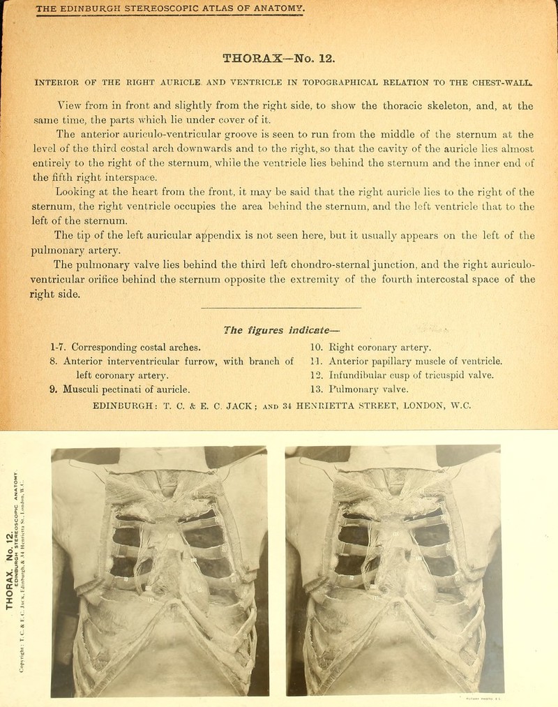 THORAX—No. 12. INTERIOR OF THE RIGHT AURICLE AND VENTRICLE IN TOPOGRAPHICAL RELATION TO THE CHEST-WALL. View from in front and slightly from the right side, to show the thoracic skeleton, and, at the same time, the parts Avhich lie under cover of it. The anterior auriculo-ventricular groove is seen to run from the middle of the sternum at the level of the third costal arch downwards and to the right, so that the cavity of the auricle lies almost entirely to the right of the sternum, while the ventricle lies behind the sternum and the inner end of the fifth right interspace. Looking at the heart from the front, it may be said that the right auricle lies to the right of the sternum, the right ventricle occupies the area behind the sternum, and the left ventricle that to the left of the sternum. The tip of the left auricular appendix is not seen here, but it usually appears on the left of the pulmonary artery. The pulmonary valve lies behind the third left chondro-sternal junction, and the right auriculo- ventricular orifice behind the sternum opposite the extremity of the fourth intercostal space of the right side. 1-7. Corresponding costal arches. 8. Anterior interventricular furrow, with branch of left coronary artery. 9. Musculi pectinati of auricle. The figures Indicate—- 10. Eight coronary artery. 1-1. Anterior papillary muscle of ventricle. 12. Infundibular cusp of tricuspid valve. 13. Pulmonary valve. EDINBURGH: T. C. & E. C. JACK 34 HENRIETTA STREET, LONDON, W.C.