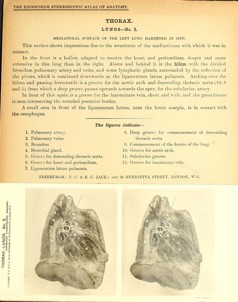 THORAX. LUNGS—No. 2. MEDIASTINAL SURFACE OF THE LEFT LUNG HARDENED IN SITU. This surface shows impressions due to the structures of the mediastinum with which it was in contact. In the front is a hollow, adapted to receive the heart and pericardium, deeper and more extensive in this lung than in the right. Above and behind it is the hilum with the divided bronchus, pulmonary artery and veins, and some lymphatic glands, surrounded by the reflection of the pleura, which is continued downwards as the ligamentum latum pulmonis. Arching over the hilum and passing downwards is a groove for the aortic arch and descending thoracic aorta (10, 8 and 5), from which a deep groove passes upwards towards the apex, for the subclavian artery. In front of this again is a groove for the innominate vein, short and wide, and the great fissure is seen intersecting the rounded posterior border. A small area in front of the ligamentum latum, near the lower margin, is in contact with the oesophagus. The figures indicate— 1. Pulmonary artery. 2. Pulmonary veins. 3. Bronchus. 4. Bronchial gland. 5. Groove for descending thoracic aorta. 6. Groove for heart and pericardium. 7. Ligamentum latum pulmonis. thoracic aorta. 9. Commencement of the fissure of the lung. 10. Groove for aortic arch. 11. Subclavian groove. 12. Groove for innominate vein. 8. Deep groove for commencement of descending