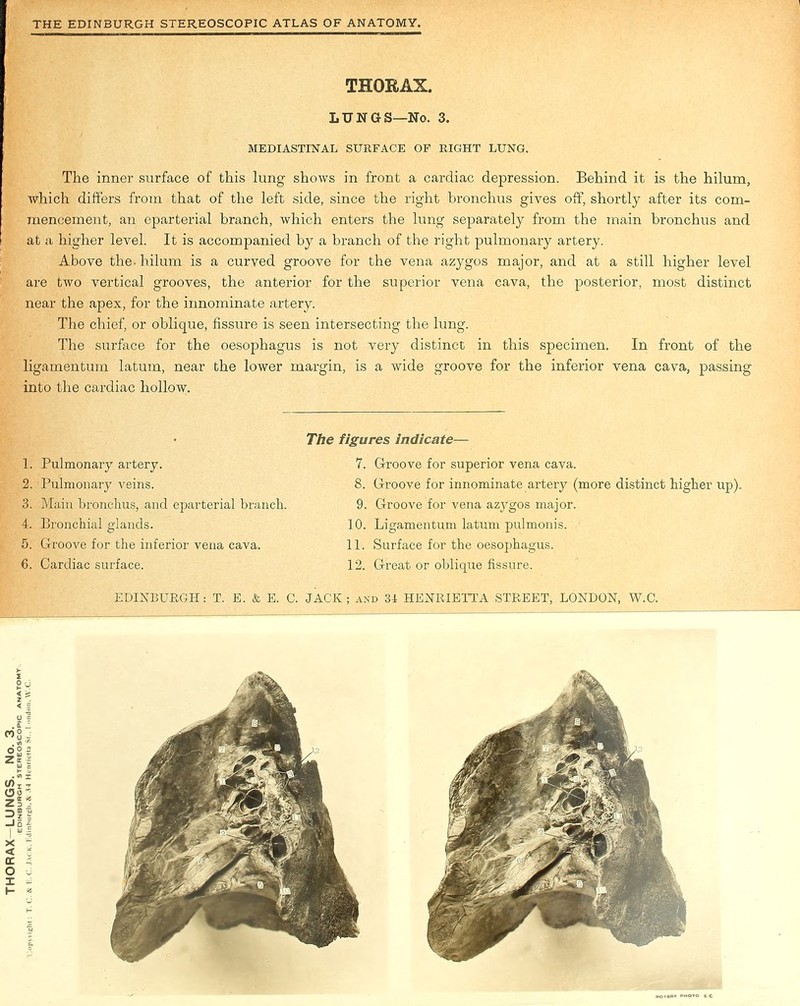 THORAX. lungs-no. 3. MEDIASTINAL SURFACE OF RIGHT LUNG. The inner surface of this lung shows in front a cardiac depression. Behind it is the hilum, which differs from that of the left side, since the right bronchus gives off, shortly after its com- mencement, an cparterial branch, which enters the lung separately from the main bronchus and at a higher level. It is accompanied by a branch of the right pulmonary artery. Above the. hilum is a curved groove for the vena azygos major, and at a still higher level are two vertical grooves, the anterior for the superior vena cava, the posterior, most distinct near the apex, for the innominate artery. The chief, or oblique, fissure is seen intersecting the lung. The surface for the oesophagus is not very distinct in this specimen. In front of the ligamentum latum, near the lower margin, is a wide groove for the inferior vena cava, passing into the cardiac hollow. 3. Main bronchus, and eparterial branch. 4. Bronchial glands. 5. Groove for the inferior vena cava. 6. Cardiac surface. 1. Pulmonary artery. 2. Pulmonary veins. The figures Indicate— 7. Groove for superior vena cava. 8. Groove for innominate artery (more distinct higher up). 9. Groove for vena azjrgos major. 10. Ligamentum latum pulmonis. 11. Surface for the oesophagus. 12. Great or oblique fissure.