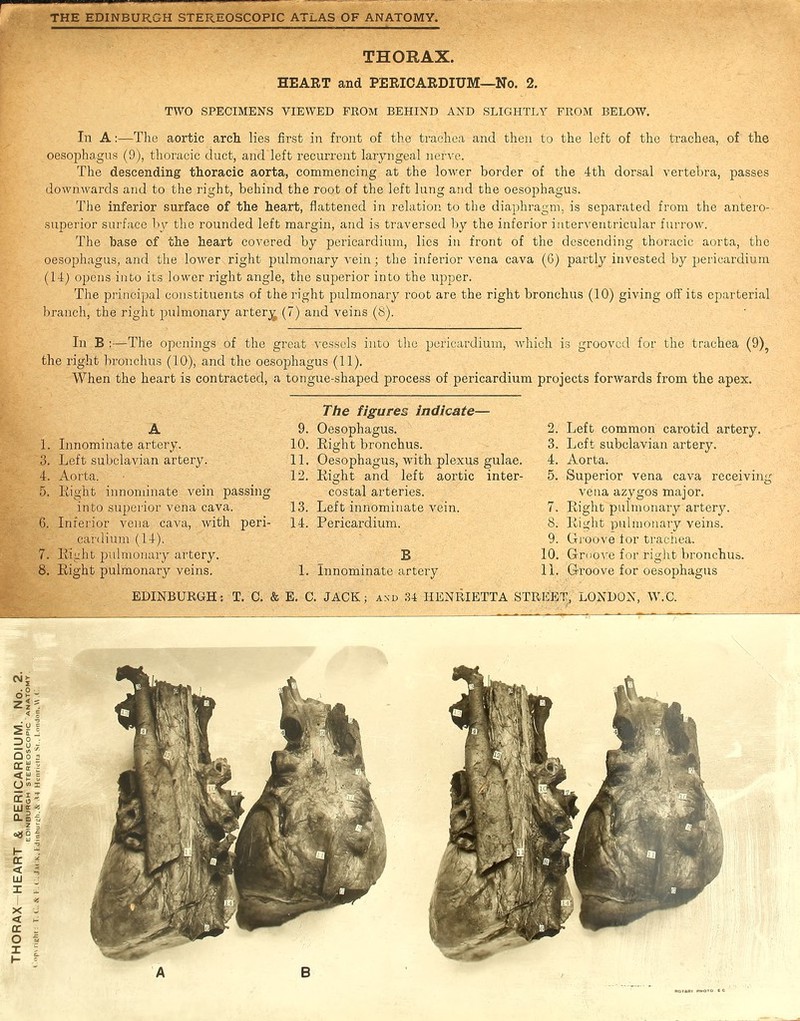 THORAX. HEART and PERICARDIUM—No. 2. TWO SPECIMENS VIEWED FROM BEHIND AND SLIGHTLY FROM BELOW. In A:—The aortic arch, lies first in front of the trachea and then to the left of the trachea, of the oesophagus (9), thoracic duct, and left recurrent laryngeal nerve. The descending thoracic aorta, commencing at the lower border of the 4th dorsal vertebra, passes downwards and to the right, behind the root of the left lung and the oesophagus. The inferior surface of the heart, flattened in relation to the diaphragm, is separated from the antero- superior surface by the rounded left margin, and is traversed by the inferior interventricular furrow. The base of the heart covered by pericardium, lies in front of the descending thoracic aorta, the oesophagus, and the lower right pulmonary vein; the inferior vena cava (6) partly invested by pericardium (14) opens into its lower right angle, the superior into the tipper. The principal constituents of the right pulmonary root are the right bronchus (10) giving off its eparterial branch, the right pulmonary artery (7) and veins (S). In B :—The openings of the great vessels into the pericardium, which is grooved for the trachea (9) the right bronchus (10), and the oesophagus (11). When the heart is contracted, a tongue-shaped process of pericardium projects forwards from the apex. The figures indicate- A 9. Oesophagus. 1. Innominate artery. 10. Right bronchus. 3. Left subclavian artery. 11. Oesophagus, with plexus gulae. 4. Aorta. 12. Right and left aortic inter- 5. Right innominate vein passing costal arteries. into superior vena cava. 13. Left innominate vein. 6. Inferior vena cava, with peri- 14. Pericardium. cardium (14). 7. Right pulmonary artery. B 6. Right pulmonary veins. 1. innominate artery. 2. Left common carotid artery. 3. Left subclavian artery. 4. Aorta. 5. Superior vena cava receiving vena azygos major. 7. Right pulmonary artery. 8. Right pulmonary veins. 9. Groove lor trachea. 10. Groove for right bronchus. 11. Groove for oesophagus