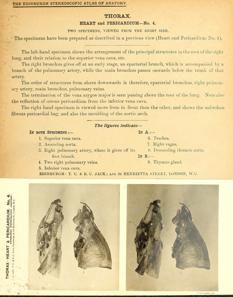 THORAX. HEART and PERICARDIUM—No. 4. TWO SPECIMENS, VIEWED FROM THE RIGHT SIDE. The specimens have been prepared as described in a previous view (Heart and Pericardium No. 1). The left-hand specimen shows the arrangement of the principal structures in the root of the right lung, and their relation to the superior vena cava, etc. The right bronchus gives off at an early stage, an eparterial branch, which is accompanied by a branch of the pulmonary artery, while the main bronchus passes onwards below the trunk of that artery. The order of structures from above downwards is therefore, eparterial bronchus, right pulmon- ary artery, main bronchus, pulmonary veins. The termination of the vena azygos major is seen passing above the root of the lung. Note also the reflection of .serous pericardium from the inferior vena cava. The right hand specimen is viewed more from in front than the other, and shows the unbroken fibrous pericardial bag, and also the moulding of the aortic arch. The figures indicate— In both Specimens:— In A:— 1. Superior vena cava. 6. Trachea. 2. Ascending aorta. 7. Eight vagus. 3. Eight pulmonary artery, where it gives off its 8. Descending thoracic aorta. first branch. IN B :— 4. Two right pulmonary veins. 9. Thymus gland. 5. Inferior vena cava.