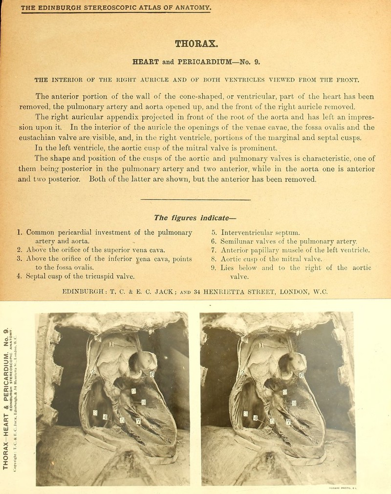 THORAX. HEART and PERICARDIUM—No. 9. THE INTERIOR OF THE RIGHT AURICLE AND OF BOTH VENTRICLES VIEWED FROM THE FRONT. The anterior portion of the wall of the cone-shaped, or ventricular, part of the heart has been removed, the pulmonary artery and aorta opened up, and the front of the right auricle removed. The right auricular appendix projected in front of the root of the aorta and has left an impres- sion upon it. In the interior of the auricle the openings of the venae cavae, the fossa ovalis and the eustachian valve are (visible, and, in the right ventricle, portions of the marginal and septal cusps. In the left ventricle, the aortic cusp of the mitral valve is prominent. The shape and position of the cusps of the aortic and pulmonary valves is characteristic, one of them being posterior in the pulmonary artery and two anterior, while in the aorta one is anterior and two posterior. Both of the latter are shown, but the anterior has been removed. The figures Indicate— 1. Common pericardial investment of the pulmonary artery and aorta. 2. Above the orifice of the superior vena cava. 3. Above the orifice of the inferior yena cava, points to the fossa ovalis. 4. Septal cusp of the tricuspid valve. 5. Interventricular septum. 6. Semilunar valves of the pulmonary artery. 7. Anterior papillary muscle of the left ventricle. 8. Aortic cusp of the mitral valve. 9. Lies below and to the right of the aortic valve.