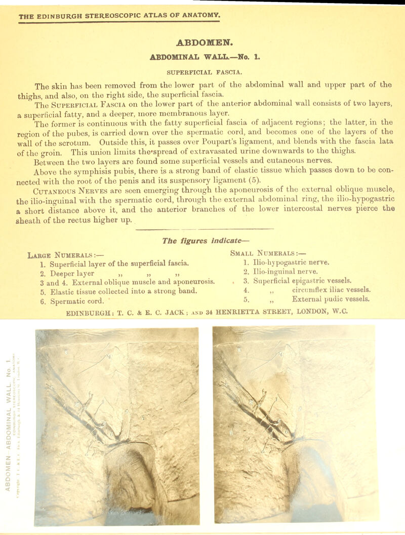 THE EDINBURGH STEREOSCOPIC ATLAS OF ANATOMY. The skin has been removed from the lower part of the abdominal wall and upper part of the thighs, and also, on the right side, the superficial fascia. The Superficial Fascia on the lower part of the anterior abdominal wall consists of two layers, a superficial fatty, and a deeper, more membranous layer. The former is continuous with the fatty superficial fascia of adjacent regions; the latter, in the reo-ion of the pubes, is carried down over the spermatic cord, and becomes one of the layers of the wall of the scrotum. Outside this, it passes over Poupart’s ligament, and blends with the fascia lata of the groin. This union limits the'spread of extravasated urine downwards to the thighs. Between the two layers are found some superficial vessels and cutaneous nerves. Above the symphisis pubis, there is a strong band of elastic tissue which passes down to be con- nected with the root of the penis and its suspensory ligament (5). Cutaneous Nerves are seen emerging through the aponeurosis of the external oblique muscle, the ilio-inguinal with the spermatic cord, through the external abdominal ring, the ilio-hypogastric a short distance above it, and the anterior branches of the lower intercostal nerves pierce the sheath of the rectus higher up. Large Numerals:— 1. Superficial layer of the superficial fascia. 2. Deeper layer „ „ „ 3 and 4. External oblique muscle and aponeurosis. 5. Elastic tissue collected into a strong band. 6. Spermatic cord. Small Numerals:— 1. Ilio-hypogastric nerve. , 3. Superficial epigastric vessels. 4. ,, circumflex iliac vessels. 5. ,, External pudic vessels.