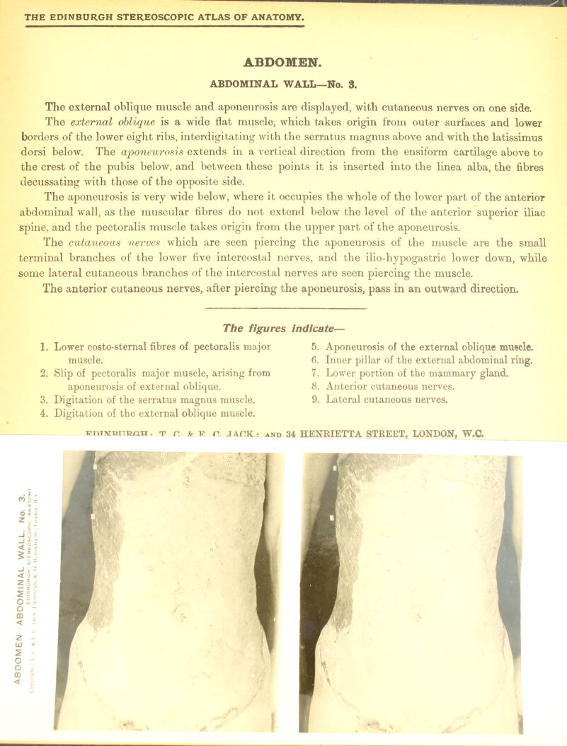The external oblique muscle and aponeurosis are displayed, with cutaneous nerves on one side. The external oblique is a wide flat muscle, which takes origin from outer surfaces and lower borders of the lower eight ribs, interdigitating with the serratus magnus above and with the latissimus dorsi below. The aponeurosis extends in a vertical direction from the ensiform cartilage above to the crest of the pubis below, and between these points it is inserted into the linea alba, the fibres decussating with those of the opposite side. The aponeurosis is very wide below, where it occupies the whole of the lower part of the anterior abdominal wall, as the muscular fibres do not extend below the level of the anterior superior iliac spine, and the pectoralis muscle takes origin from the upper part of the aponeurosis. The cutaneous nerves which are seen piercing the aponeurosis of the muscle are the small terminal branches of the lower five intercostal nerves, and the ilio-hypogastric lower down, while some lateral cutaneous branches of the intercostal nerves are seen piercing the muscle. The anterior cutaneous nerves, after piercing the aponeurosis, pass in an outward direction. muscle. 2. Slip of pectoralis major muscle, arising from aponeurosis of external oblique. 3. Digitation of the serratus magnus muscle. 4. Digitation of the external oblique muscle. 6. Inner pillar of the external abdominal ring. 7. Lower portion of the mammary gland. 8. Anterior cutaneous nerves. 9. Lateral cutaneous nerves.