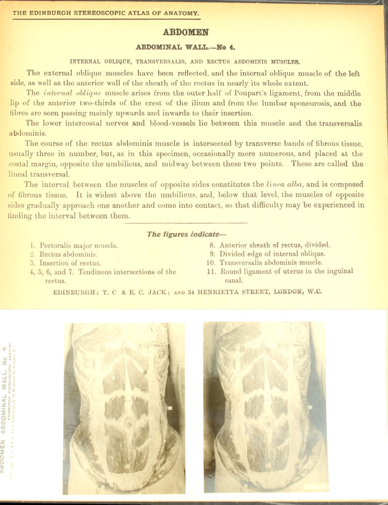 INTERNAL OBLIQUE, TRANSYERSALIS, AND RECTUS ABDOMINIS MUSCLES. The external oblique muscles have been reflected, and the internal oblique muscle of the left side, as well as the anterior wall of the sheath of the rectus in nearly its whole extent. The internal oblique muscle arises from the outer half of Poupart’s ligament, from the middle lip of the anterior two-thirds of the crest of the ilium and from the lumbar aponeurosis, and the fibres are seen passing mainly upwards and inwards to their insertion. The lower intercostal nerves and blood-vessels lie between this muscle and the transversalis abdominis. The course of the rectus abdominis muscle is intersected by transverse bands of fibrous tissue, usually three in number, but, as in this specimen, occasionally more numerous, and placed at the costal margin, opposite the umbilicus, and midway between these two points. These are called the lineal transversal. The interval between the muscles of opposite sides constitutes the linea alba, and is composed of fibrous tissue. It is widest above the umbilicus, and, below that level, the muscles of opposite sides gradually approach one another and come into contact, so that difficulty may be experienced in finding the interval between them. 1. Pectoralis major muscle. 8. Anterior sheath of rectus, divided. 2. Rectus abdominis. 9. Divided edge of internal oblique. 3. Insertion of rectus. 10. Transversalis abdominis muscle. rectus. canal. 2 - f 2-