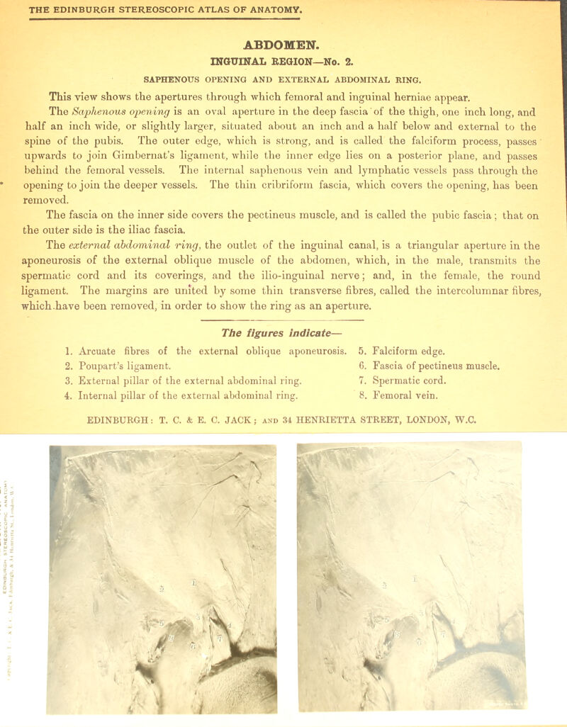 ABDOMEN. INGUINAL REGION—No. 2. SAPHENOUS OPENING AND EXTERNAL ABDOMINAL RING. This view shows the apertures through which femoral and inguinal herniae appear. The Sajphenous opening is an oval aperture in the deep fascia' of the thigh, one inch long, and half an inch wide, or slightly larger, situated about an inch and a half below and external to the spine of the pubis. The outer edge, which is strong, and is called the falciform process, passes upwards to join Gimbernat’s ligament, while the inner edge lies on a posterior plane, and passes behind the femoral vessels. The internal saphenous vein and lymphatic vessels pass through the opening to join the deeper vessels. The thin cribriform fascia, which covers the opening, has been removed. The fascia on the inner side covers the pectineus muscle, and is called the pubic fascia; that on the outer side is the iliac fascia. The external abdominal ring, the outlet of the inguinal canal, is a triangular aperture in the aponeurosis of the external oblique muscle of the abdomen, which, in the male, transmits the spermatic cord and its coverings, and the ilio-inguinal nerve; and, in the female, the round ligament. The margins are united by some thin transverse fibres, called the intercolumnar fibres, which.have been removed, in order to show the ring as an aperture. The figures indicate— 1. Arcuate fibres of the external oblique aponeurosis. 5. Falciform edge. 2. Poupart’s ligament. 6. Fascia of pectineus muscle. 3. External pillar of the external abdominal ring. 7. Spermatic cord. 4. Internal pillar of the external abdominal ring. 8. Femoral vein.