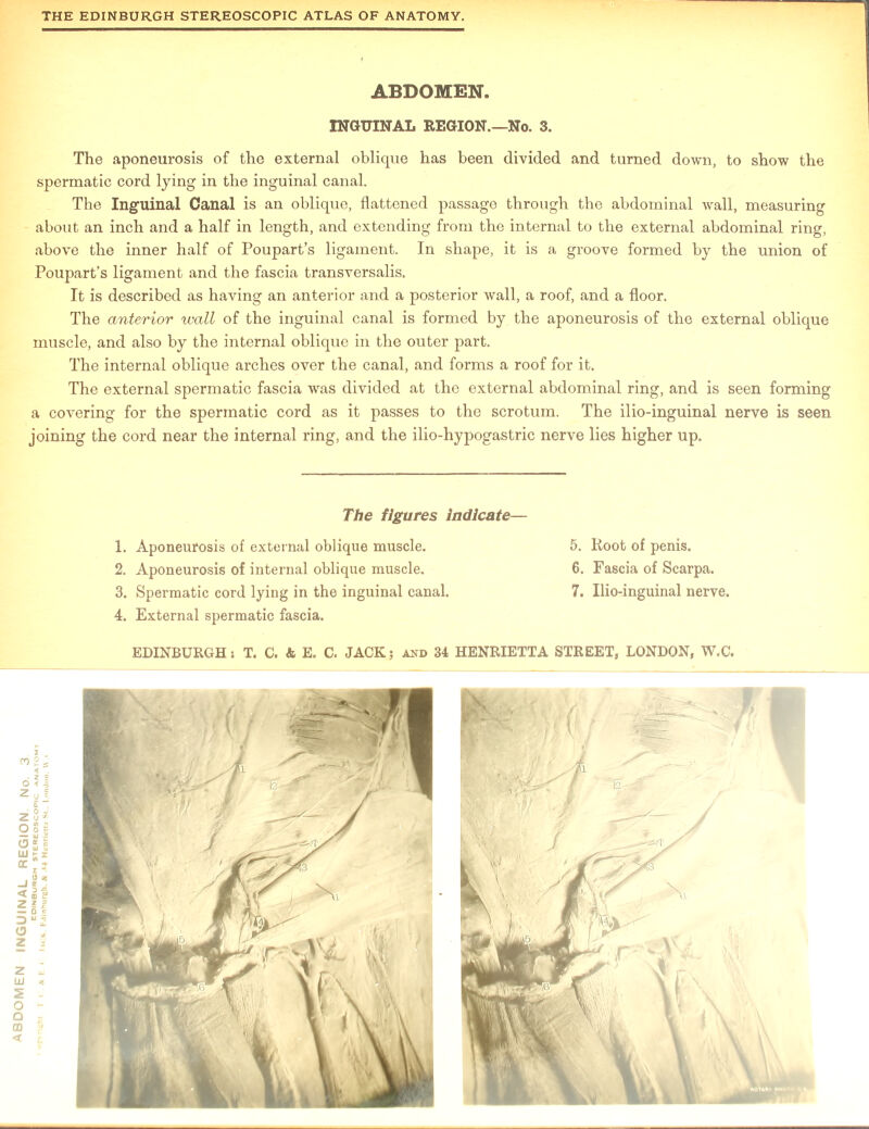The aponeurosis of the external oblique has been divided and turned down, to show the spermatic cord lying in the inguinal canal. The Inguinal Canal is an oblique, flattened passage through the abdominal wall, measuring about an inch and a half in length, and extending from the internal to the external abdominal ring, above the inner half of Poupart’s ligament. In shape, it is a groove formed by the union of Poupart’s ligament and the fascia transversalis. It is described as having an anterior and a posterior wall, a roof, and a floor. The anterior wall of the inguinal canal is formed by the aponeurosis of the external oblique muscle, and also by the internal oblique in the outer part. The internal oblique arches over the canal, and forms a roof for it. The external spermatic fascia was divided at the external abdominal ring, and is seen forming a covering for the spermatic cord as it passes to the scrotum. The ilio-inguinal nerve is seen joining the cord near the internal ring, and the ilio-hypogastric nerve lies higher up. 4. External spermatic fascia.