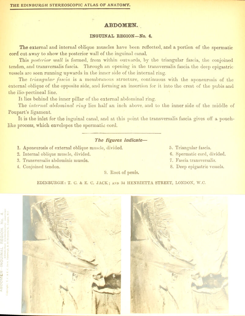 The external and internal oblique muscles have been reflected, and a portion of the spermatic cord cut away to show the posterior wall of the inguinal canal. This posterior wall is formed, from within outwards, by the triangular fascia, the conjoined tendon, and transversalis fascia. Through an opening in the transversalis fascia the deep epigastric vessels are seen running upwards in the inner side of the internal ring. The triangular fascia is a membranous structure, continuous with the aponeurosis of the external oblique of the opposite side, and forming an insertion for it into the crest of the pubis and the ilio-pectineal line. It lies behind the inner pillar of the external abdominal ring. The internal abdominal ring lies half an inch above, and to the inner side of the middle of Poupart’s ligament. It is the inlet for the inguinal canal, and at this point the transversalis fascia gives off a pouch- like process, which envelopes the spermatic cord. 3. Transversalis abdominis muscle. 9. Root of penis. 7. Fascia transversalis.