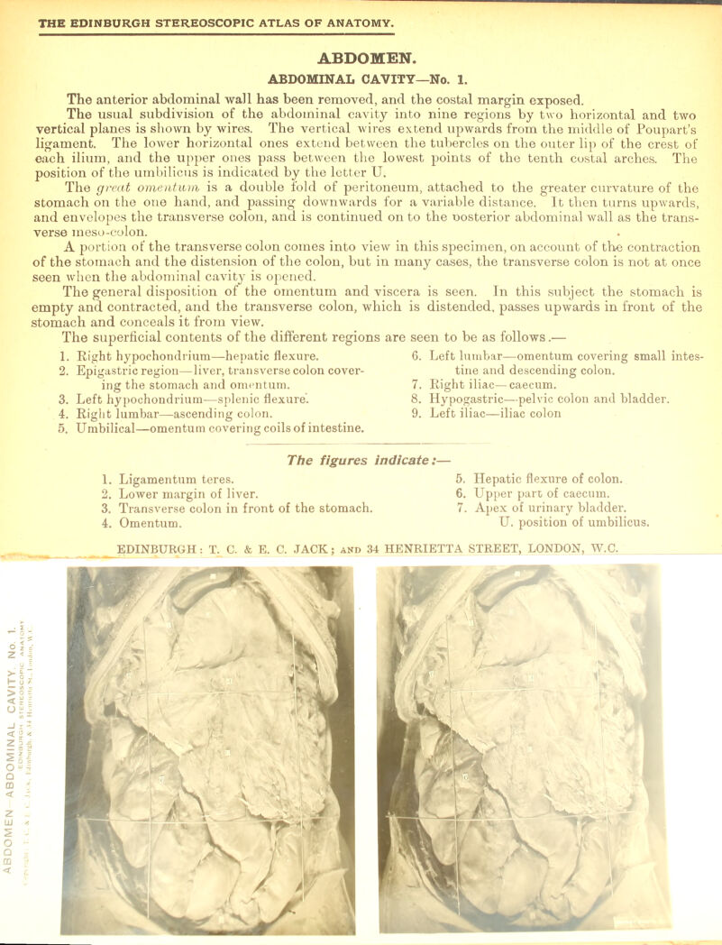 The anterior abdominal wall has been removed, and the costal margin exposed. The usual subdivision of the abdominal cavity into nine regions by two horizontal and two vertical planes is shown by wires. The vertical wires extend upwards from the middle of Poupart’s ligament. The lower horizontal ones extend between the tubercles on the outer lip of the crest of each ilium, and the upper ones pass between the lowest points of the tenth costal arches. The position of the umbilicus is indicated by the letter U. The great omentum is a double fold of peritoneum, attached to the greater curvature of the stomach on the one hand, and passing downwards for a variable distance. It then turns upwards, and envelopes the transverse colon, and is continued on to the nosterior abdominal wall as the trans- verse meso-colon. of the stomach and the distension of the colon, but in many cases, the transverse colon is not at once seen when the abdominal cavity is opened. The general disposition of the omentum and viscera is seen. In this subject the stomach is empty and contracted, and the transverse colon, which is distended, passes upwards in front of the stomach and conceals it from view. The superficial contents of the different regions are seen to be as follows.— 1. Right hypochondrium—hepatic flexure. 2. Epigastric region—liver, transverse colon cover- ing the stomach and omentum. 3. Left hypochondrium—splenic flexure. 4. Right lumbar—ascending colon. 5. Umbilical—omentum covering coils of intestine. 6. Left lumbar—omentum covering small intes- tine and descending colon. 7. Right iliac—caecum. 8. Hypogastric—pelvic colon and bladder. 9. Left iliac—iliac colon 1. Ligamentum teres. 2. Lower margin of liver. 3. Transverse colon in front of the stomach. 4. Omentum. 5. Hepatic flexure of colon. 6. Upper part of caecum. 7. Apex of urinary bladder. U. position of umbilicus.