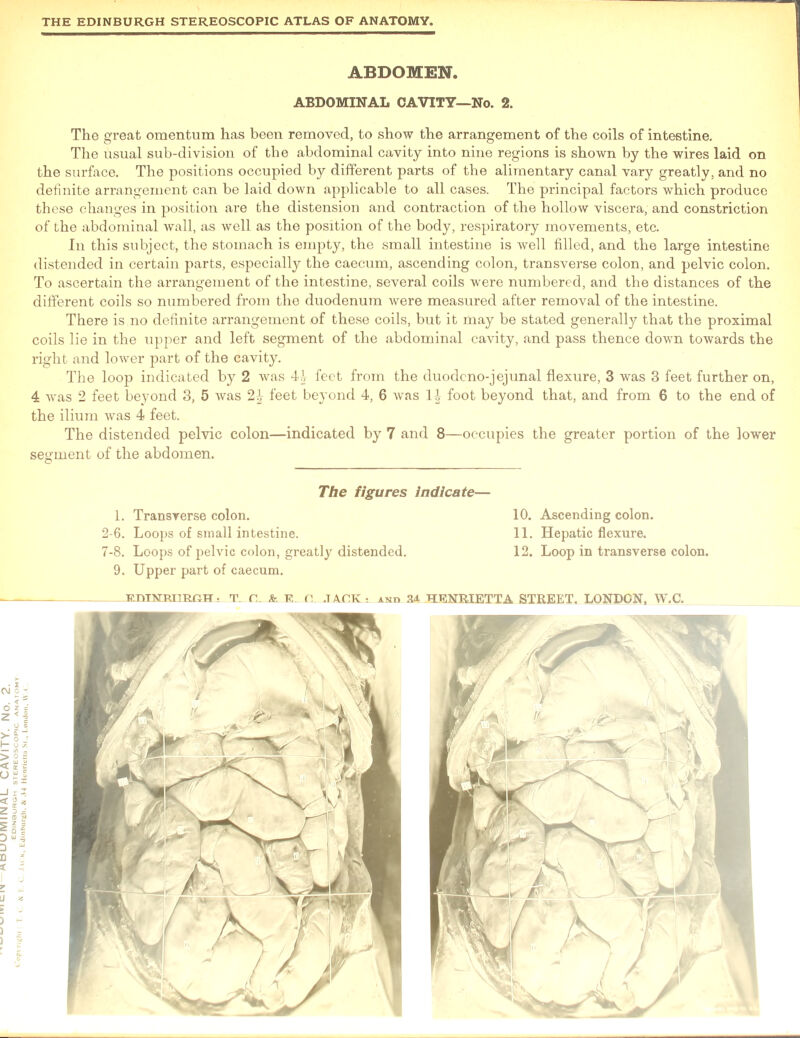 ABDOMEN. ABDOMINAL CAVITY—No. 2. The great omentum has been removed, to show the arrangement of the coils of intestine. The usual sub-division of the abdominal cavity into nine regions is shown by the wires laid on the surface. The positions occupied by different parts of the alimentary canal vary greatly, and no definite arrangement can be laid down applicable to all cases. The principal factors which produce these changes in position are the distension and contraction of the hollow viscera, and constriction of the abdominal wall, as well as the position of the body, respiratory movements, etc. In this subject, the stomach is empty, the small intestine is well filled, and the large intestine distended in certain parts, especially the caecum, ascending colon, transverse colon, and pelvic colon. To ascertain the arrangement of the intestine, several coils were numbered, and the distances of the different coils so numbered from the duodenum were measured after removal of the intestine. There is,no definite arrangement of these coils, but it may be stated generally that the proximal coils lie in the upper and left segment of the abdominal cavity, and pass thence down towards the right and lower part of the cavity. The loop indicated by 2 was 4>b feet from the duodcno-jejunal flexure, 3 was 3 feet further on, 4 was 2 feet beyond 3, 5 was 2| feet beyond 4, 6 was 1| foot beyond that, and from 6 to the end of the ilium was 4 feet. The distended pelvic colon—indicated by 7 and 8—occupies the greater portion of the lower segment of the abdomen. The figures indicate— Transverse colon. 10. Ascending colon. Loops of small intestine. 11. Hepatic flexure. Loops of pelvic colon, greatly distended. 12. Loop in transverse colon. Upper part of caecum.