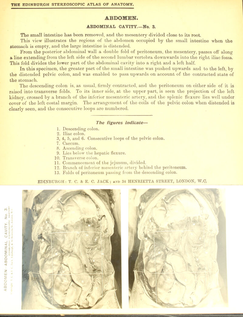 The small intestine has been removed, and the mesentery divided close to its root. This view illustrates the regions of the abdomen occupied by the small intestine when the stomach is empty, and the large intestine is distended. From the posterior abdominal wall a double fold of peritoneum, the mesentery, passes off along a line extending from the left side of the second lumbar vertebra downwards into the right iliac fossa. This fold divides the lower part of the abdominal cavity into a right and a left half. In this specimen, the greater part of the small intestine was pushed upwards and to the left, by the distended pelvic colon, and was enabled to pass upwards on account of the contracted state of the stomach. The descending colon is, as usual, firmly contracted, and the peritoneum on either side of it is raised into transverse folds. To its inner side, at the upper part, is seen the projection of the left kidney, crossed by a branch of the inferior mesenteric artery, and the splenic flexure lies well under cover of the left costal margin. The arrangement of the coils of the pelvic colon when distended is clearly seen, and the consecutive loops are numbered. 1. Descending colon. 2. Iliac colon. 3. 4, 5, and 6. Consecutive loops of the pelvic colon. 7. Caecum. 8. Ascending colon. 9. Lies below the hepatic flexure. 10. Transverse colon. 12. Branch of inferior mesenteric artery behind the peritoneum. 13. Folds of peritoneum passing from the descending colon.