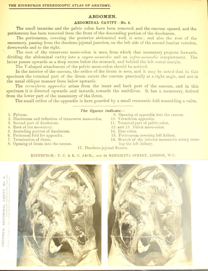 The small intestine and the pelvic colon have been removed, and the caecum opened, and the peritoneum has been removed from the front of the descending portion of the duodenum. The peritoneum, covering the posterior abdominal wall, is seen; and also the root of the mesentery, passing from the duodeno-jejunal junction, on the left side of the second lumbar vertebra, downwards and to the right. The root of the transverse meso-colon is seen, from which that mesentery projects forwards, dividing the abdominal cavity into a supra-mesocolic and an infra-mesocolic compartment. The latter passes upwards as a deep recess below the stomach, and behind the left costal margin. The V-shaped attachment of the pelvic meso-colon should be noticed. In the interior of the caecum, the orifice of the ileum is seen, and it may be noted that in this specimen the terminal part of the ileum enters the caecum practically at a right angle, and not in the usual oblique manner from below upwards. The vermiform appendix arises from the inner and back part of the caecum, and in this specimen it is directed upwards and inwards, towards the umbilicus. It has a mesentery, derived from the lower part of the mesentery of the ileum. The small orifice of the appendix is here guarded by a small crescentic fold resembling a valve. 1. Pylorus. 2. Duodenum and reflection of transverse meso-colon. 4. Root of the mesentery. 6. Peritoneal fold for appendix. 7. Termination of ileum. 8. Opening of ileum into the caecum. 17. Duodeno-j 9. Opening of appendix into the caecum. 10. Vermiform appendix. 12. and 13. Pelvic meso-colon. 15. Peritoneum covering left kidney. 16. Branch of the inferior mesenteric artery cross- ing the left kidney. junal flexure.