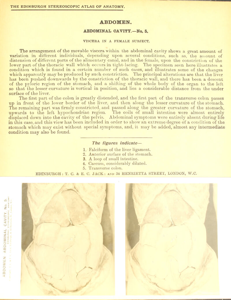 The arrangement of the movable viscera within the abdominal cavity shows a great amount of variation in different individuals, depending upon several conditions, such as, the amount of distension of different parts of the alimentary canal, and in the female, upon the constriction of the lower part of the thoracic wall which occurs in tight-lacing. The specimen seen here illustrates a condition which is found in a certain number of such cases, and illustrates some of the changes which apparently may be produced by such constriction. The principal alterations are that the liver has been pushed downwards by the constriction of the thoracic wall, and there has been a descent of the pyloric region of the stomach, and a shifting of the whole body of the organ to the left so that the lesser curvature is vertical in position, and lies a considerable distance from the under surface of the liver. The first part of the colon is greatly distended, and the first part of the transverse colon passes up in front of the lower border of the liver, and then along the lesser curvature of the stomach. The remaining part was firmly constricted, and passed along the greater curvature of the stomach, upwards to the left hypochondriac region. The coils of small intestine were almost entirely displaced down into the cavity of the pelvis. Abdominal symptoms were entirely absent during life in this case, and this view has been included in order to show an extreme degree of a condition of the stomach which may exist without special symptoms, and, it may be added, almost any intermediate condition may also be found. 1. Falciform of the liver ligament. 3. A loop of small intestine. 4. Caecum, considerably dilated.