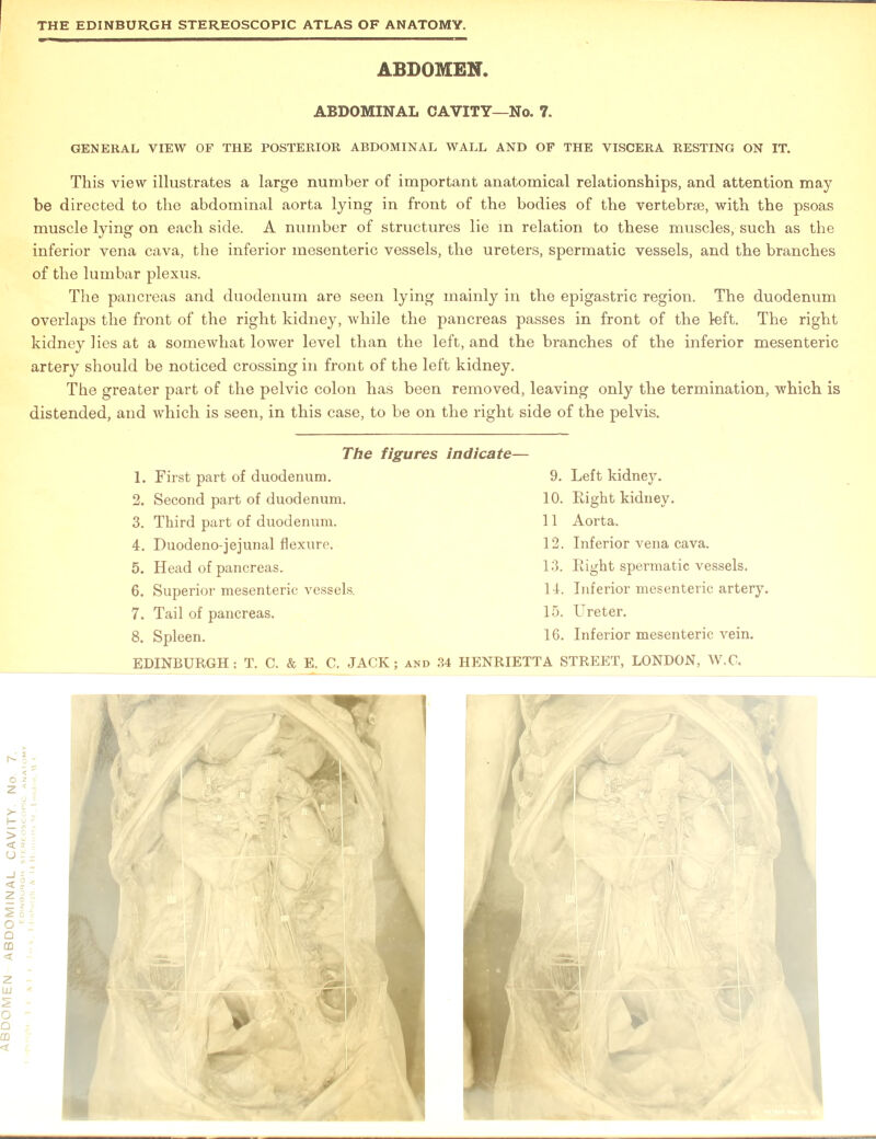 GENERAL VIEW OF THE POSTERIOR ABDOMINAL WALL AND OF THE VISCERA RESTING ON IT. This view illustrates a large number of important anatomical relationships, and attention may be directed to the abdominal aorta lying in front of the bodies of the vertebrae, with the psoas muscle lying on each side. A number of structures lie in relation to these muscles, such as the inferior vena cava, the inferior mesenteric vessels, the ureters, spermatic vessels, and the branches of the lumbar plexus. The pancreas and duodenum are seen lying mainly in the epigastric region. The duodenum overlaps the front of the right kidney, while the pancreas passes in front of the left. The right kidney lies at a somewhat lower level than the left, and the branches of the inferior mesenteric artery should be noticed crossing in front of the left kidney. The greater part of the pelvic colon has been removed, leaving only the termination, which is distended, and which is seen, in this case, to be on the right side of the pelvis. 3. Third part of duodenum. 4. Duodeno-jejunal flexure. 5. Head of pancreas. 6. Superior mesenteric vessels. 7. Tail of pancreas. 8. Spleen. 12. Inferior vena cava. 13. Right spermatic vessels. 14. Inferior mesenteric artery. 15. Ureter. 16. Inferior mesenteric vein.